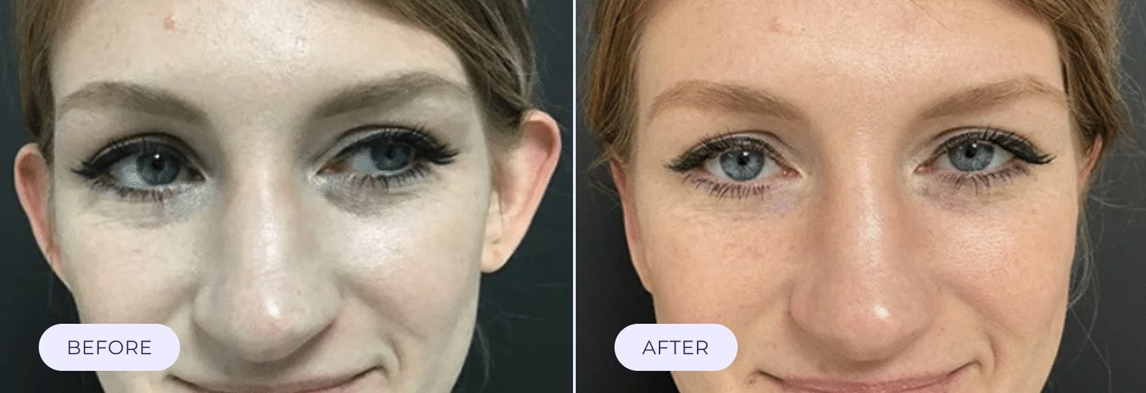 Side-by-side comparison of a woman's face labeled 'Before' and 'After', showing skincare or cosmetic treatment results.