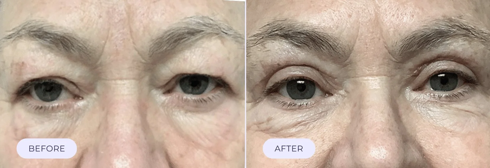 Close-up of a person's eyes and forehead showing a comparison of skin appearance before and after treatment. The left side labeled 'BEFORE' shows more wrinkles and sagging, while the right side labeled 'AFTER' shows smoother skin with fewer wrinkles.