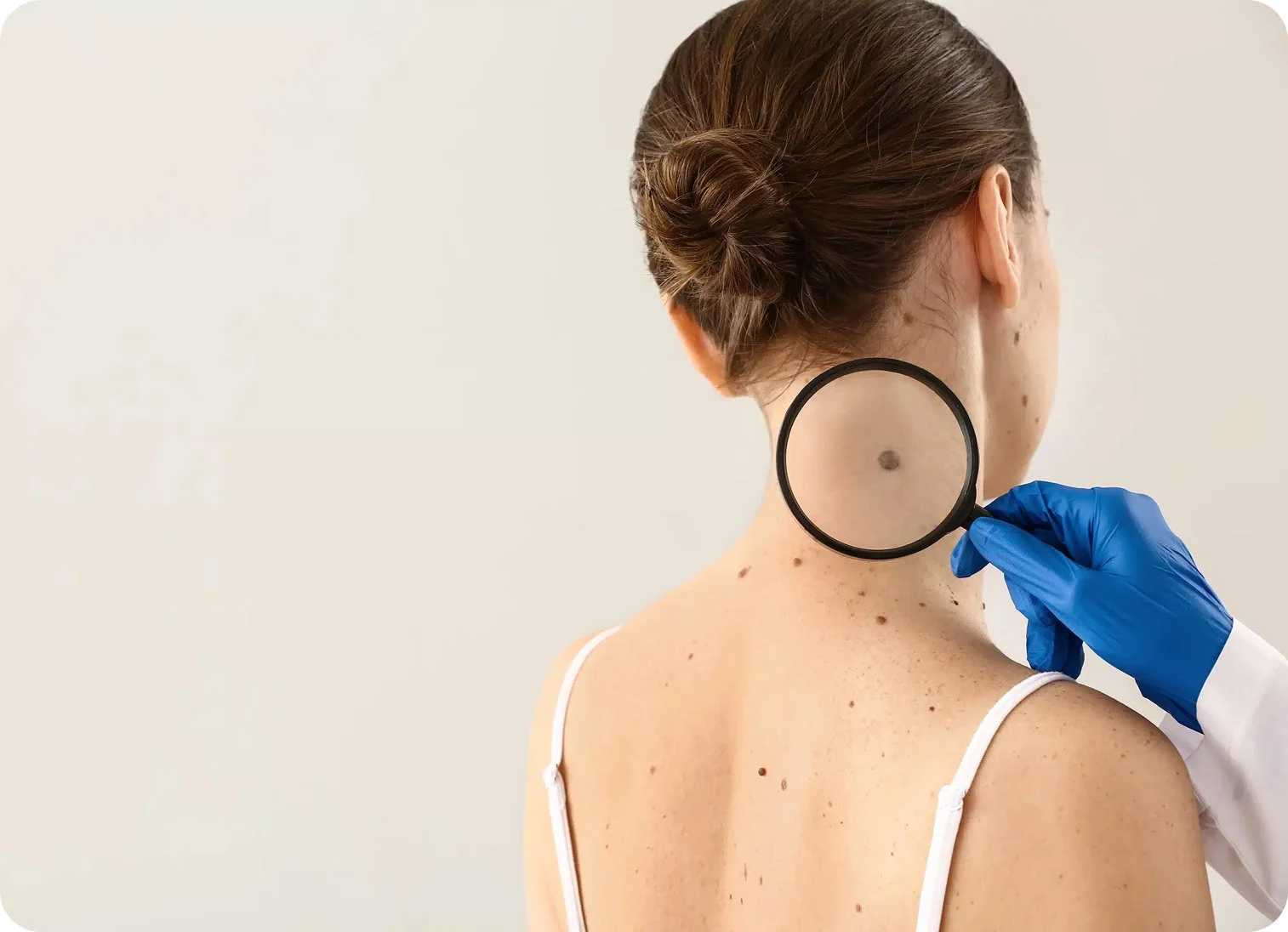 A healthcare professional wearing blue gloves examining a woman with a magnifying glass, focusing on a large mole on the back of her neck.