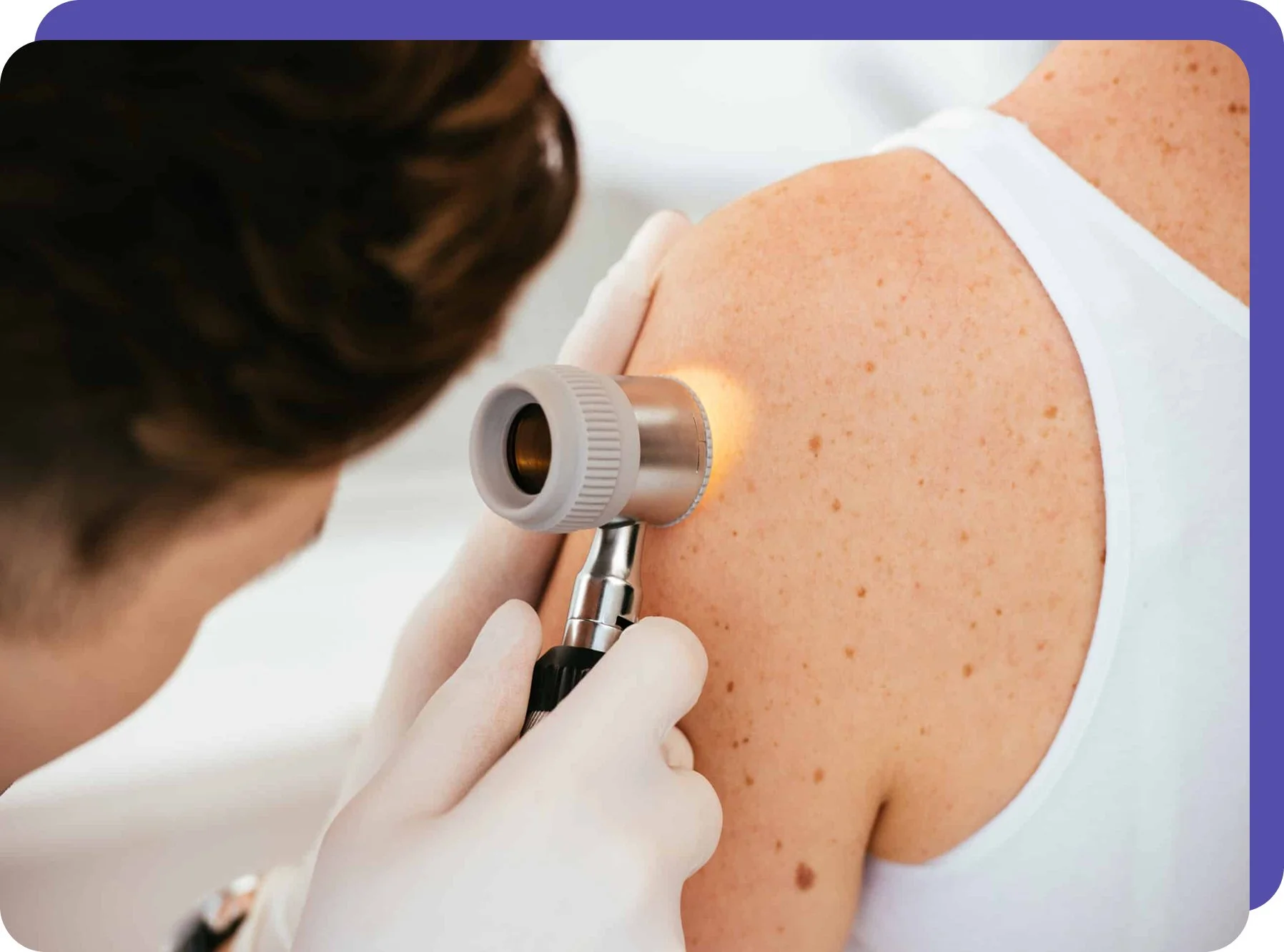 A healthcare professional performs a skin examination on a person's shoulder using a dermatoscope.