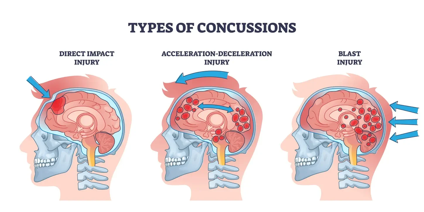 Diagram showing three types of concussions: direct impact injury, acceleration-deceleration injury, and blast injury, with illustrations of brain impacts and damage.