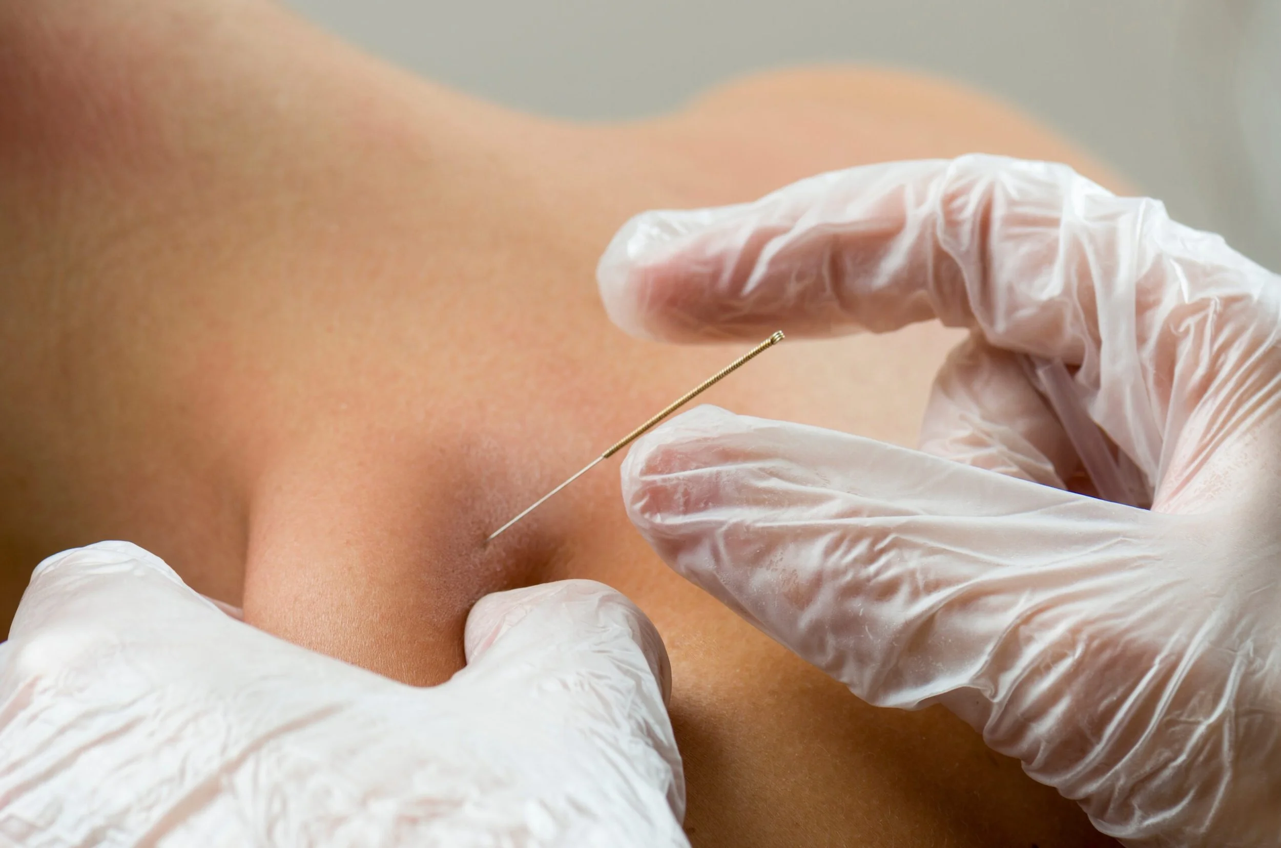 Close-up of a medical professional's gloved hand inserting a needle into a patient's arm for vaccination or medical injection.
