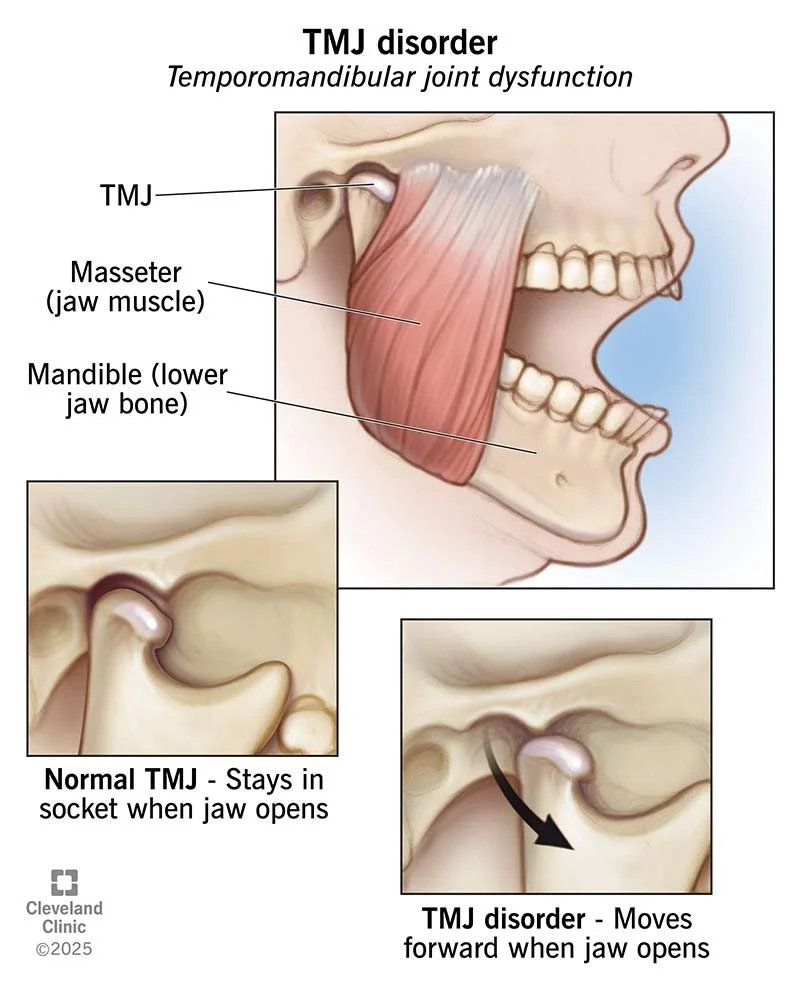 Diagram of TMJ disorder showing TMJ, masseter muscle, and lower jaw bone. It compares a normal TMJ that stays in the socket when the jaw opens with a TMJ disorder where the joint moves forward when the jaw opens.