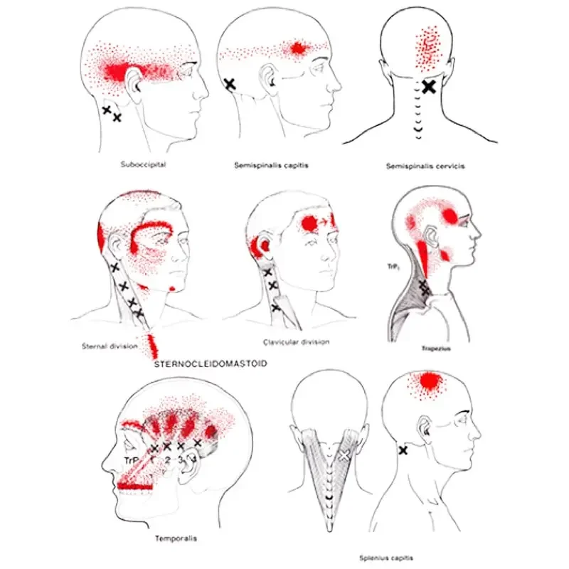 Diagram showing neural stimulation points on the head and neck, with red areas indicating affected regions.