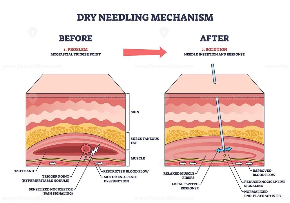 Diagram showing the dry needling mechanism, comparing the 'Before' and 'After' states. The 'Before' side depicts issues like trigger points, sensitized nociceptors, restricted blood flow, and motor end-plate dysfunction. The 'After' side shows improved blood flow, relaxed muscle fibers, and normalized activity after needle insertion and response.