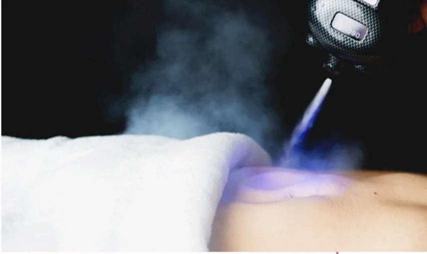 Laser treatment on skin with medical device emitting light and steam or smoke.