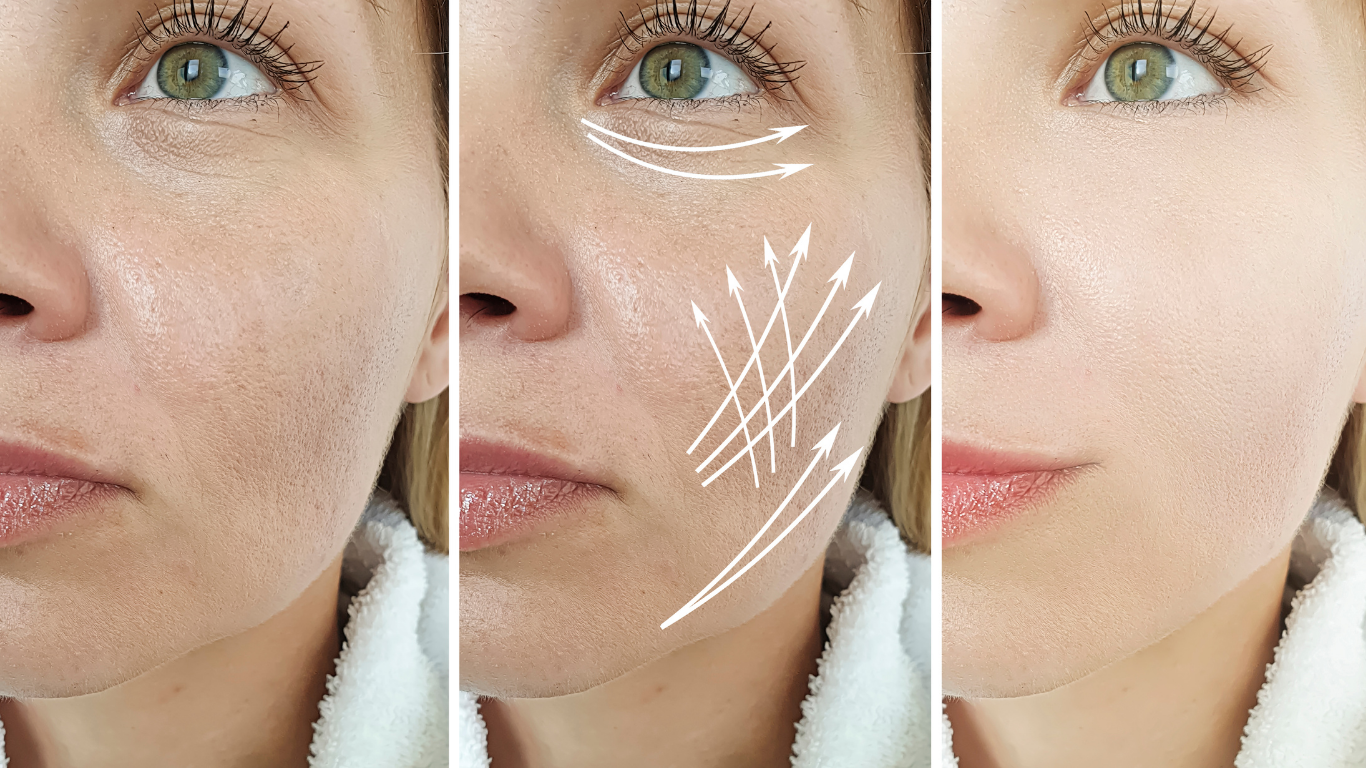 A woman receiving a facial treatment, showing before, during, and after stages. The middle image has white arrows indicating the direction of facial massage or application.