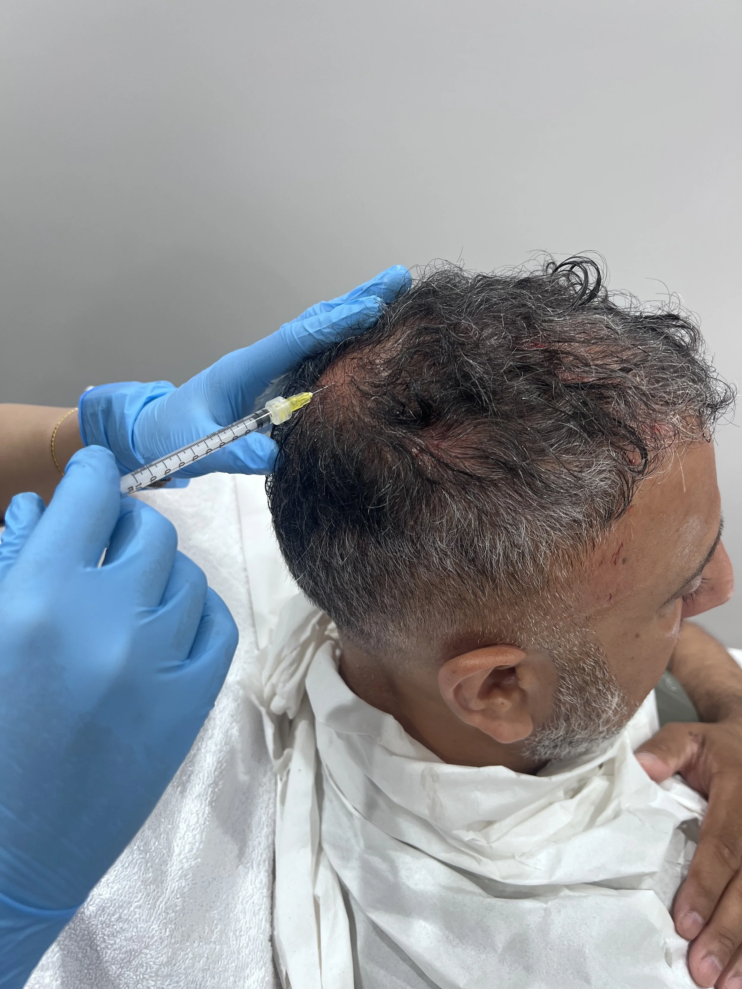 Medical professional wearing pink gloves administering a vaccination or injection to a person's scalp with a syringe.