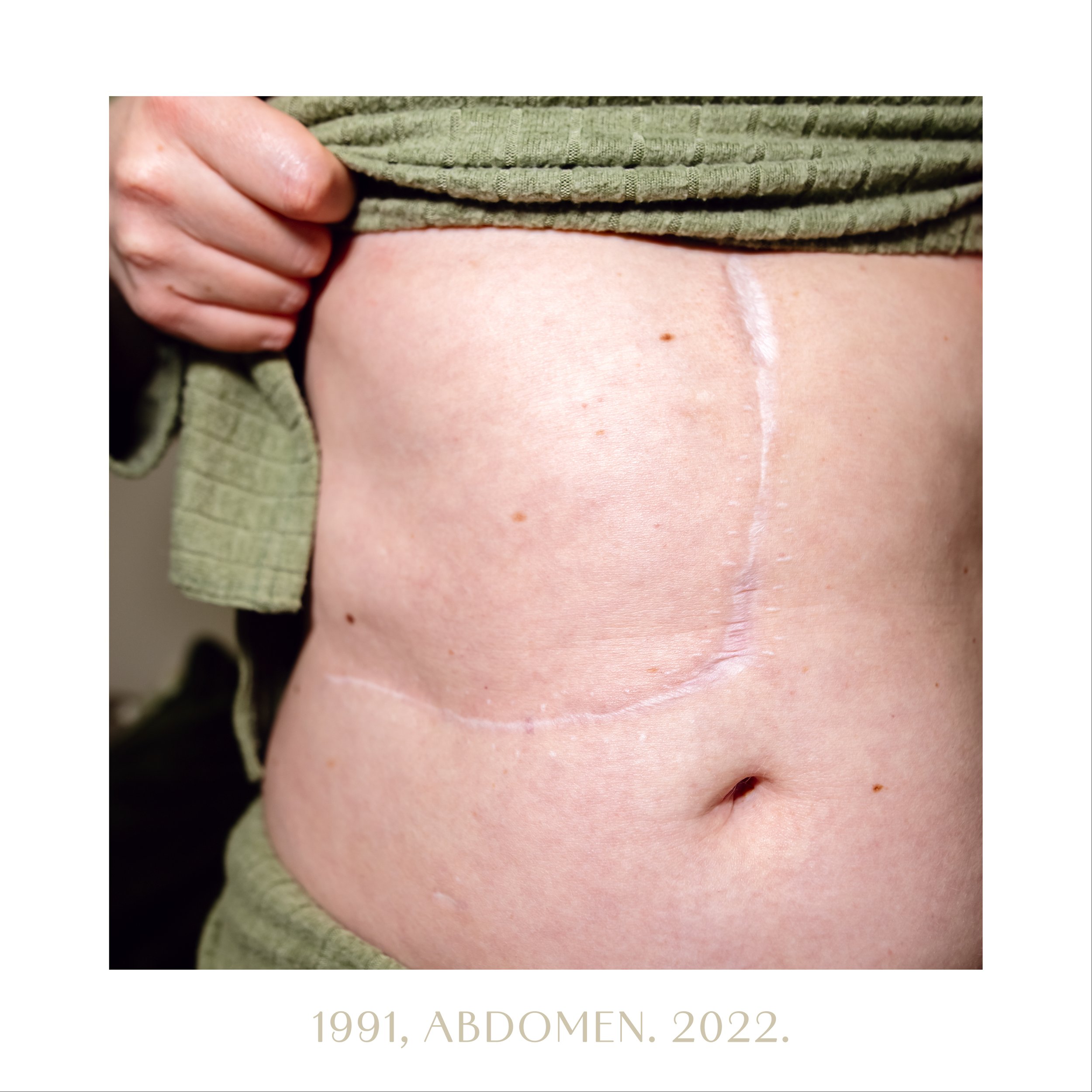 1991, abdomen. 2022.jpg