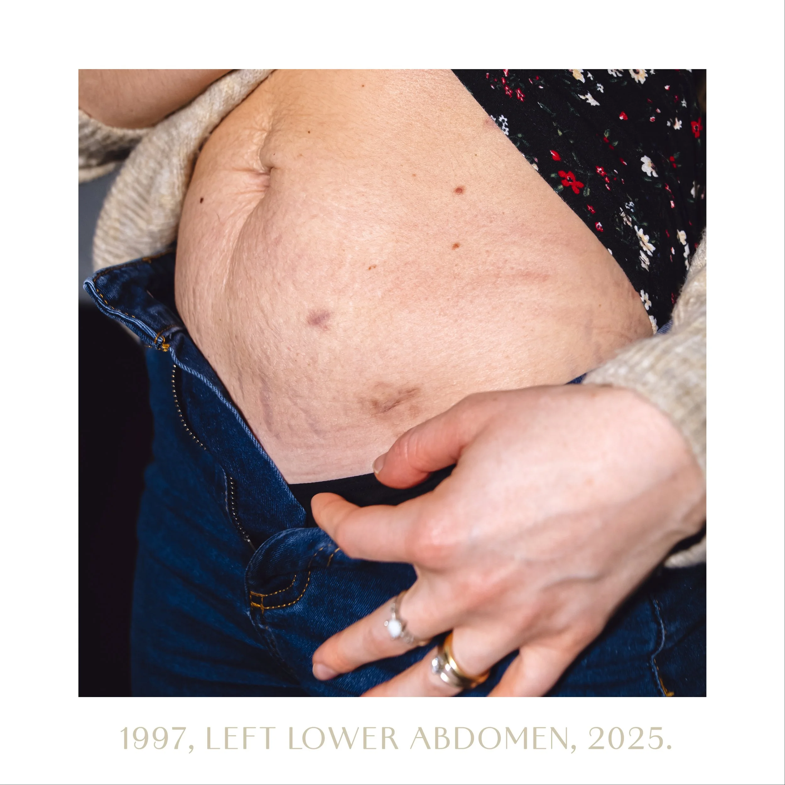 1997, left lower abdomen, 2025.jpg