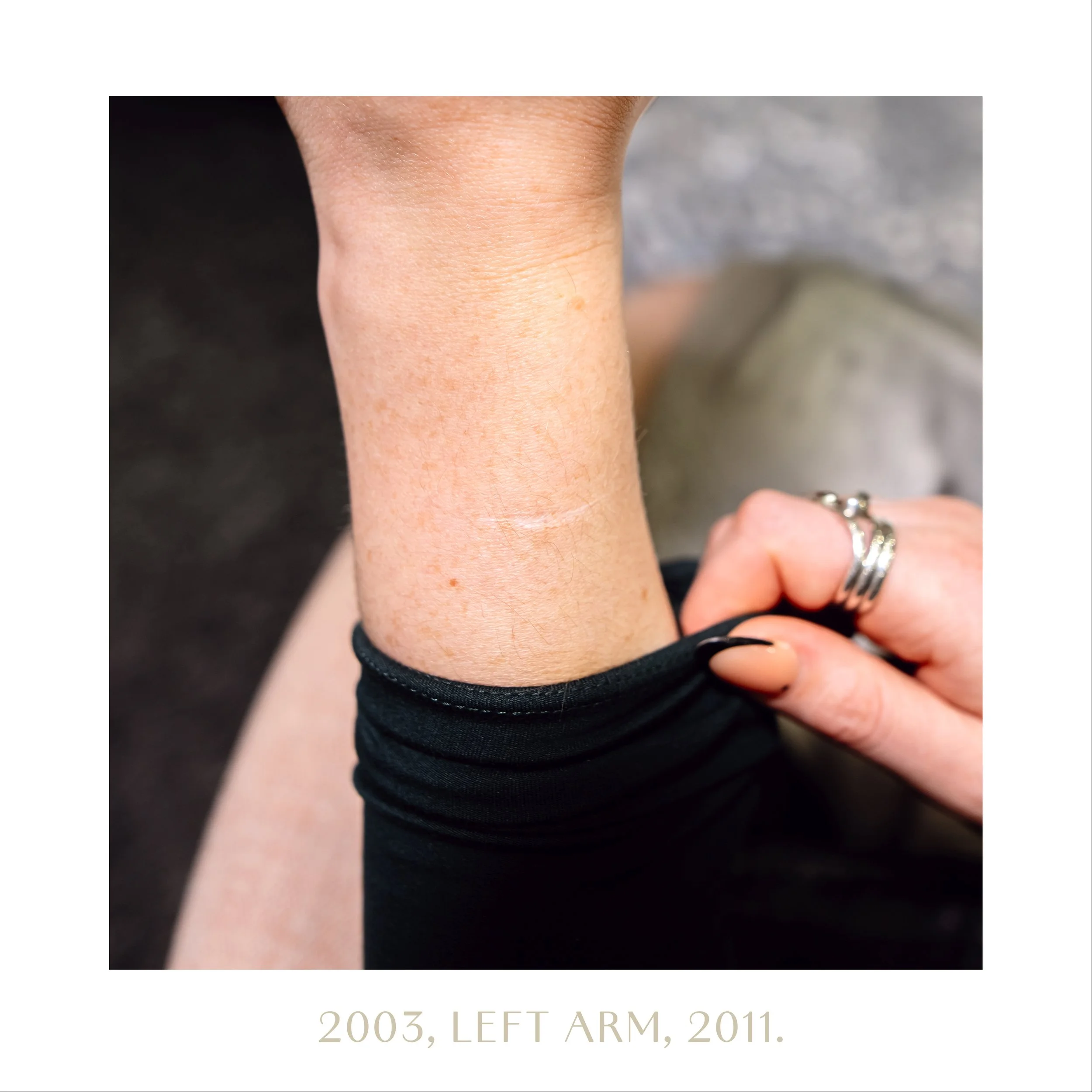 2003, left arm, 2011.jpg