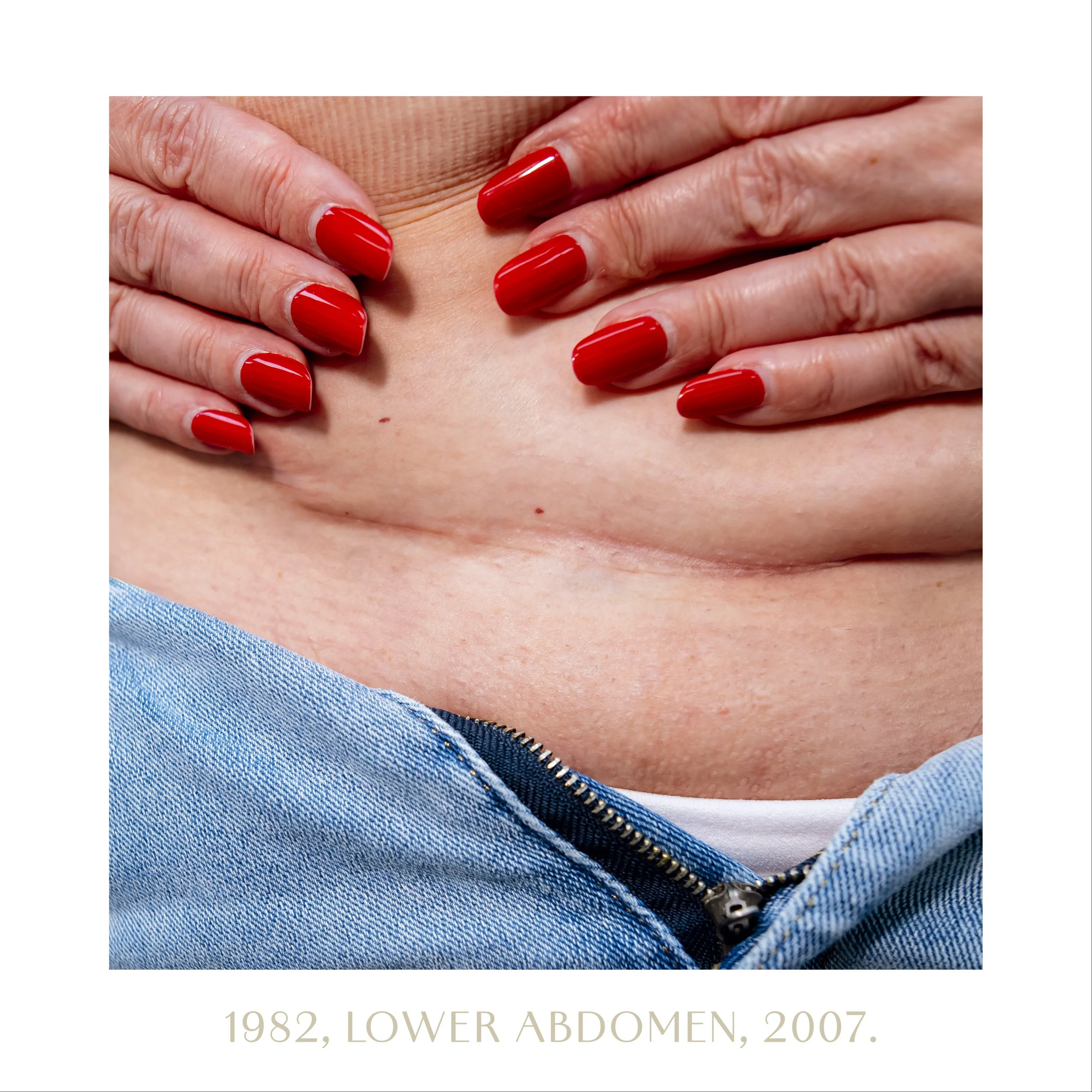 1982, lower abdomen, 2007.jpg