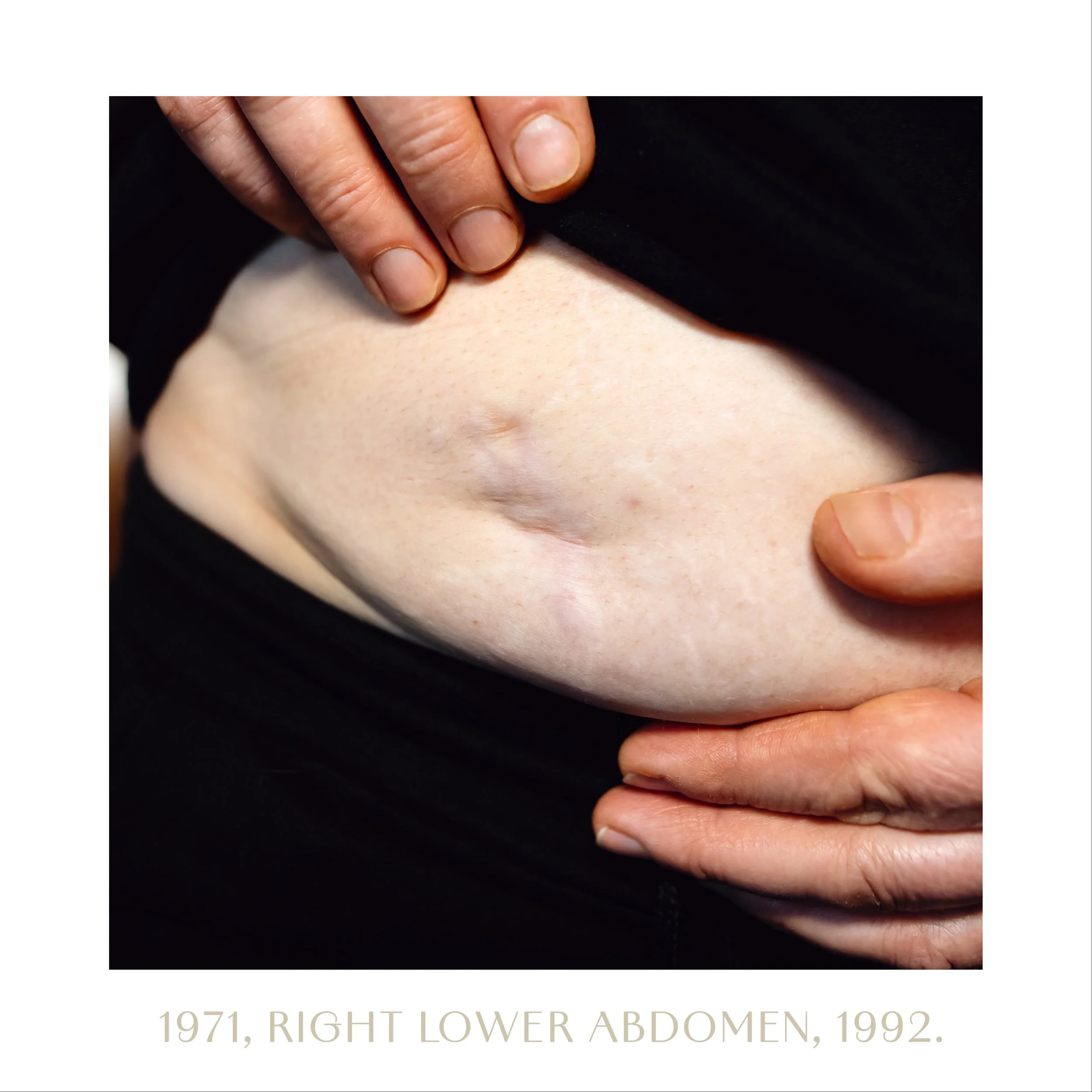 1971, right lower abdomen, 1992.jpg