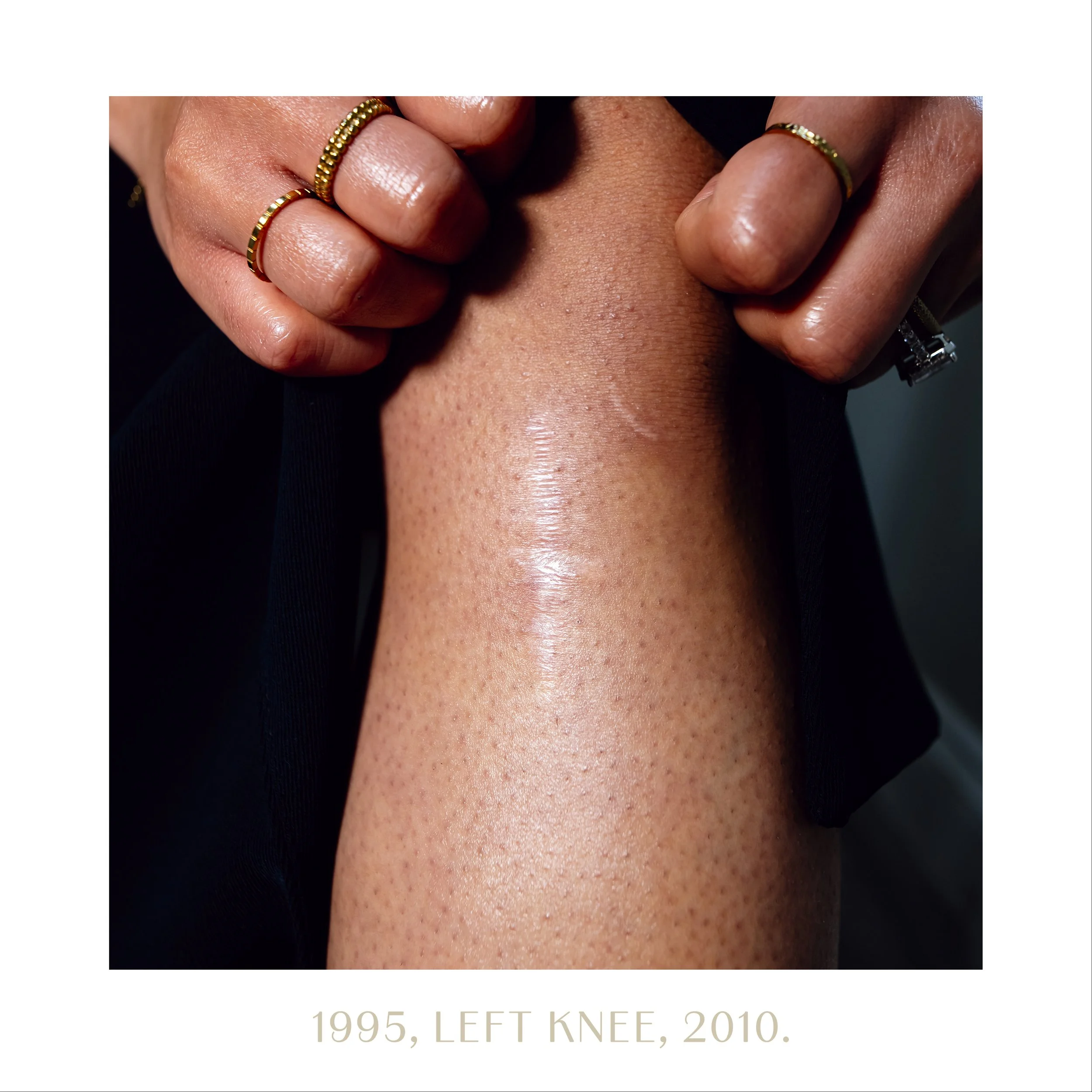1995, left knee, 2010.jpg