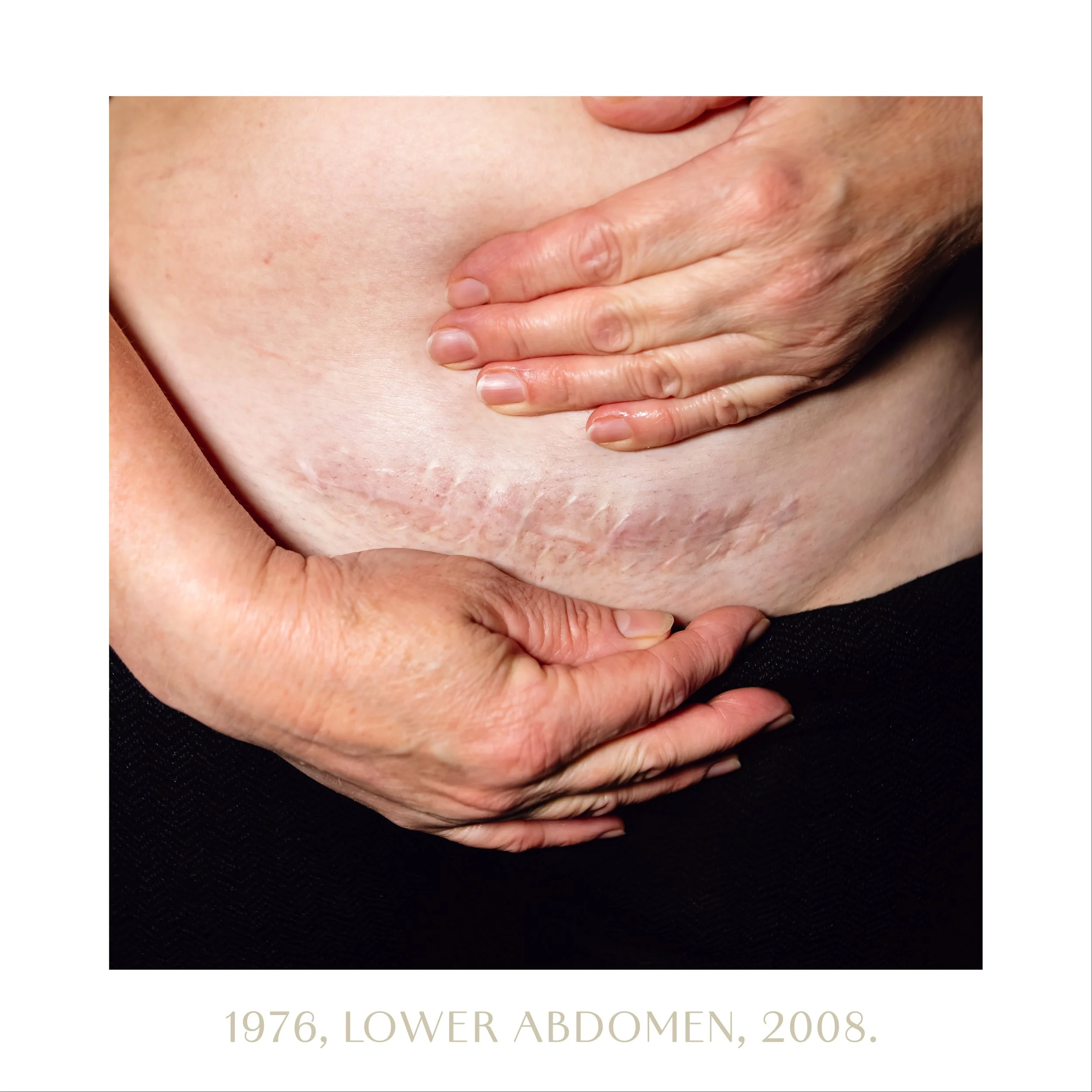1976, lower abdomen, 2008.jpg