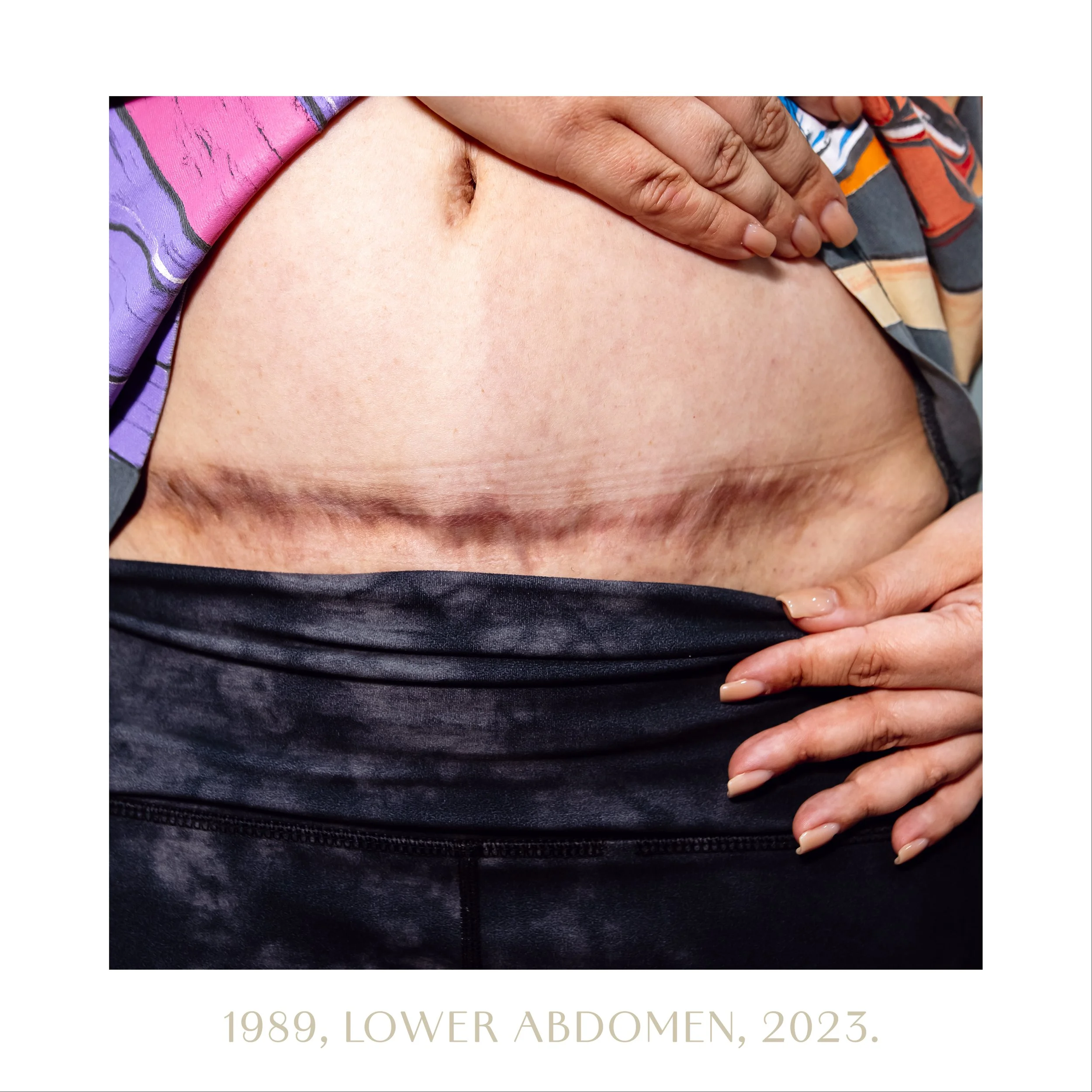 1989, lower abdomen, 2023.jpg