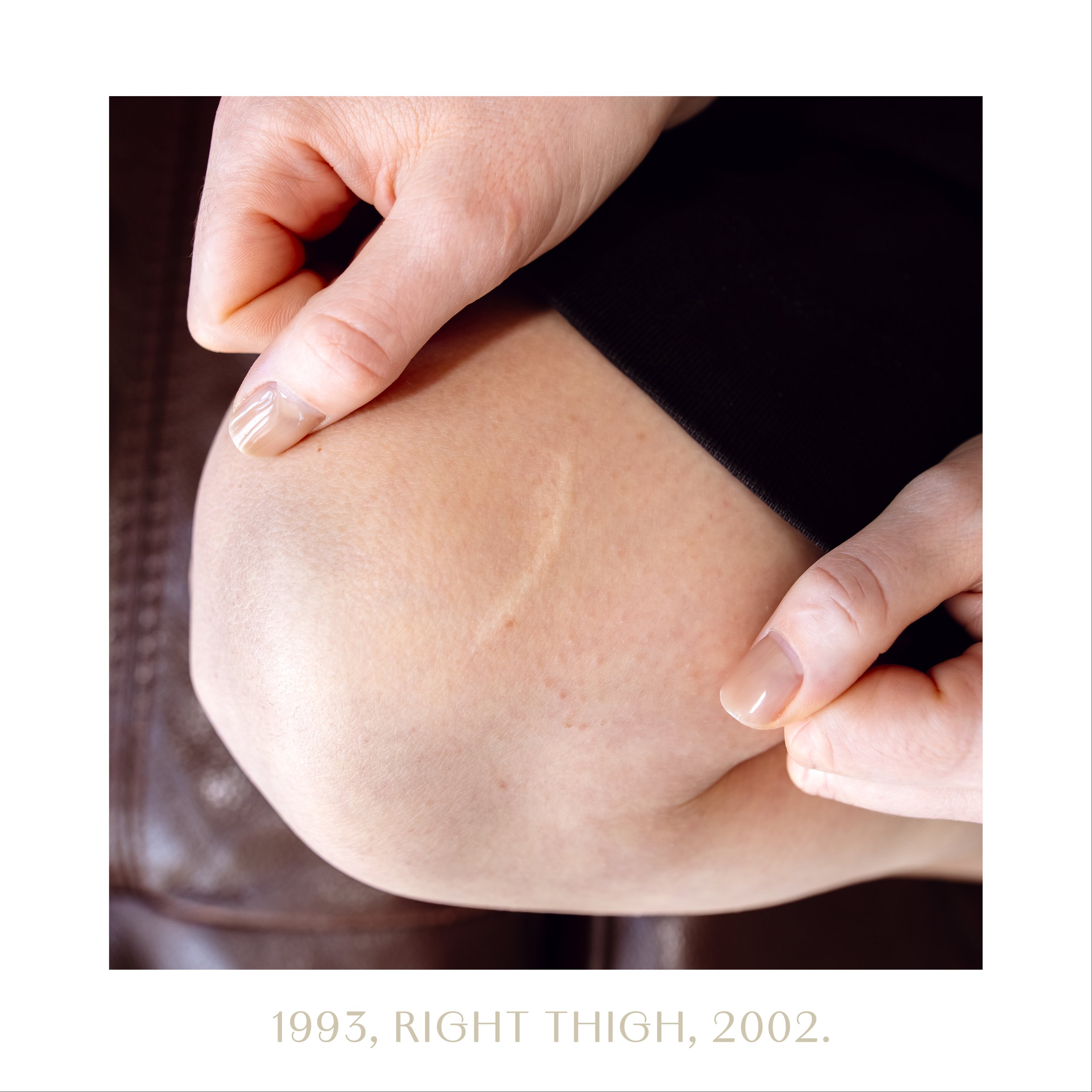 1993, right thigh, 2002.jpg