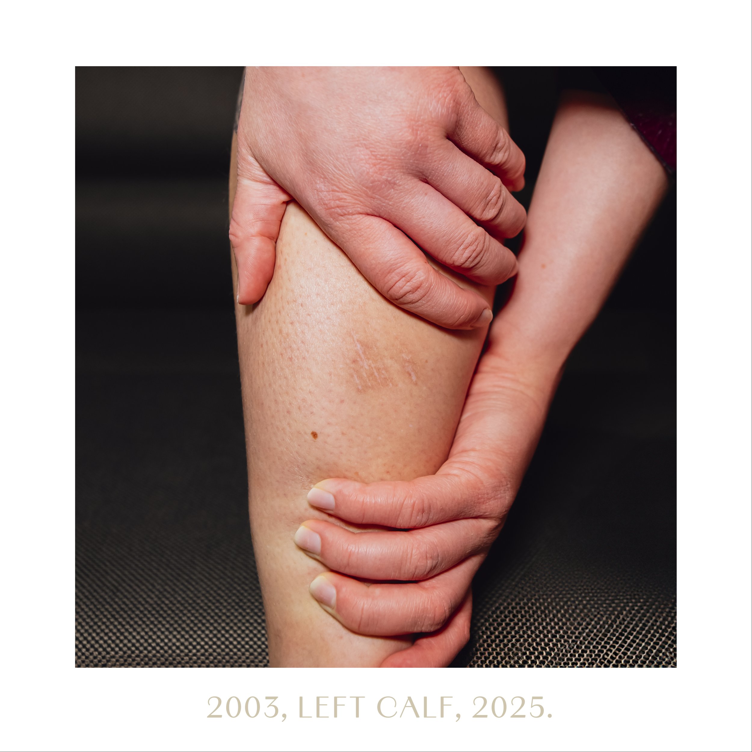 2003, left calf, 2025.jpg