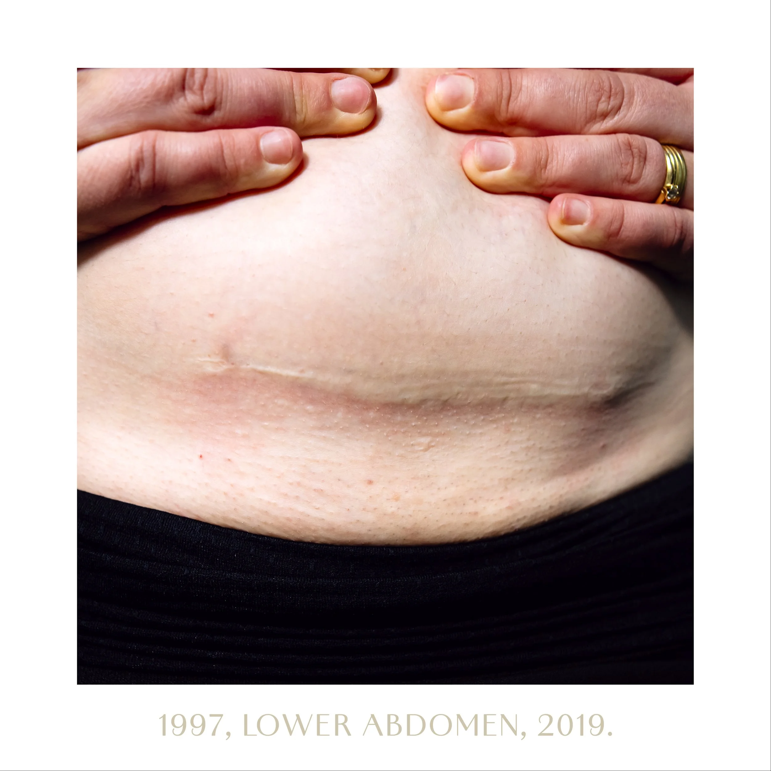 1997, lower abdomen, 2019.jpg