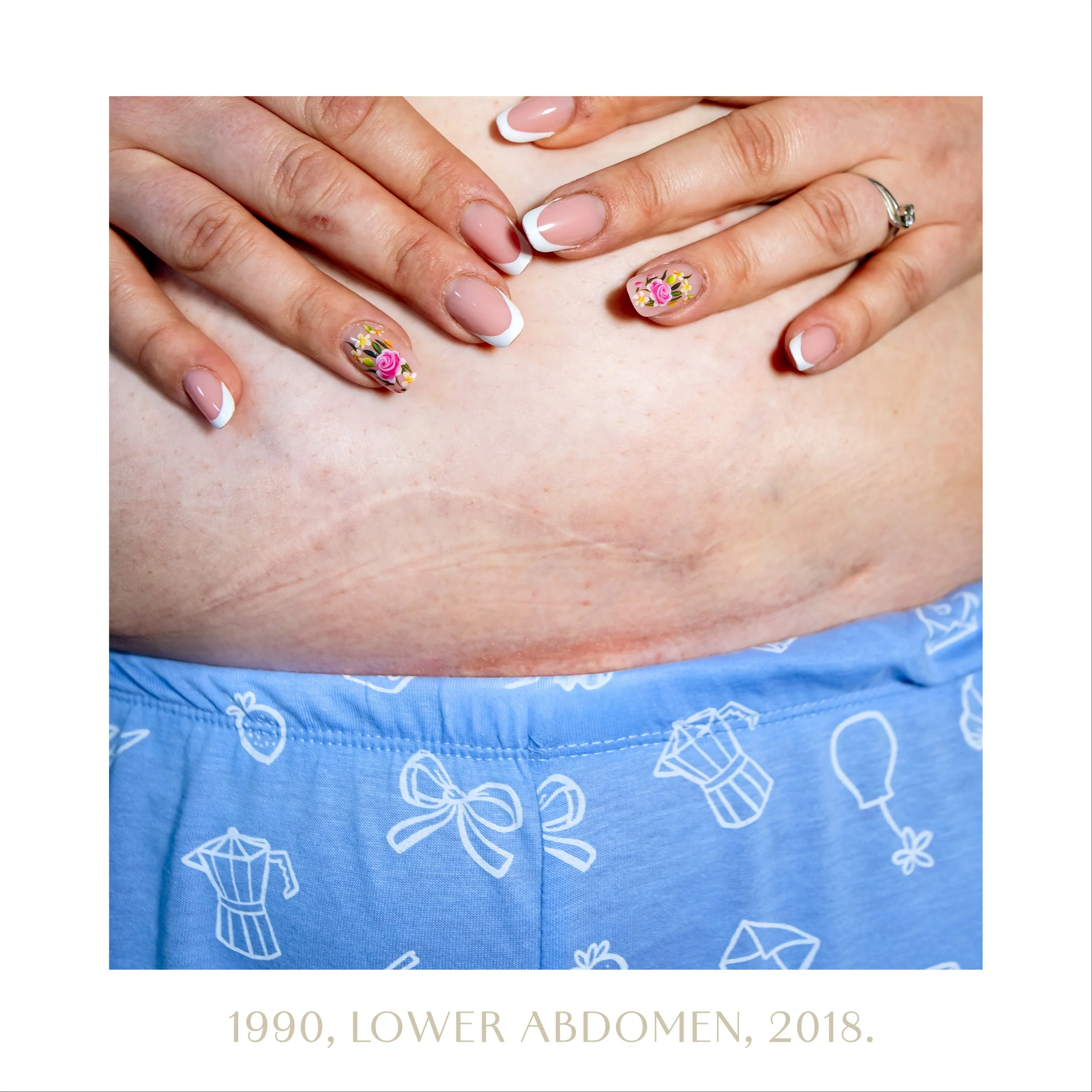 1990, lower abdomen, 2018.jpg