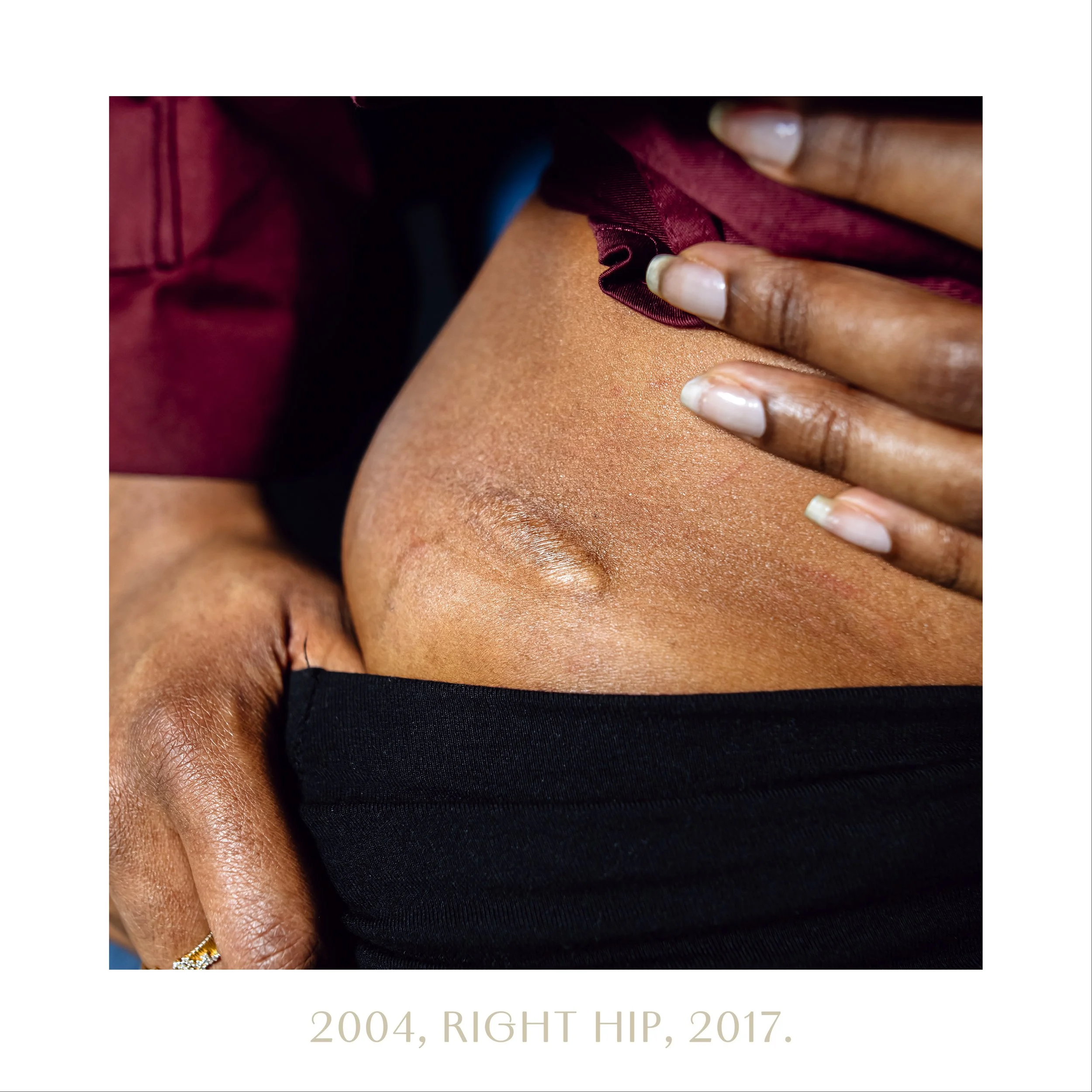 2004, right hip, 2017.jpg