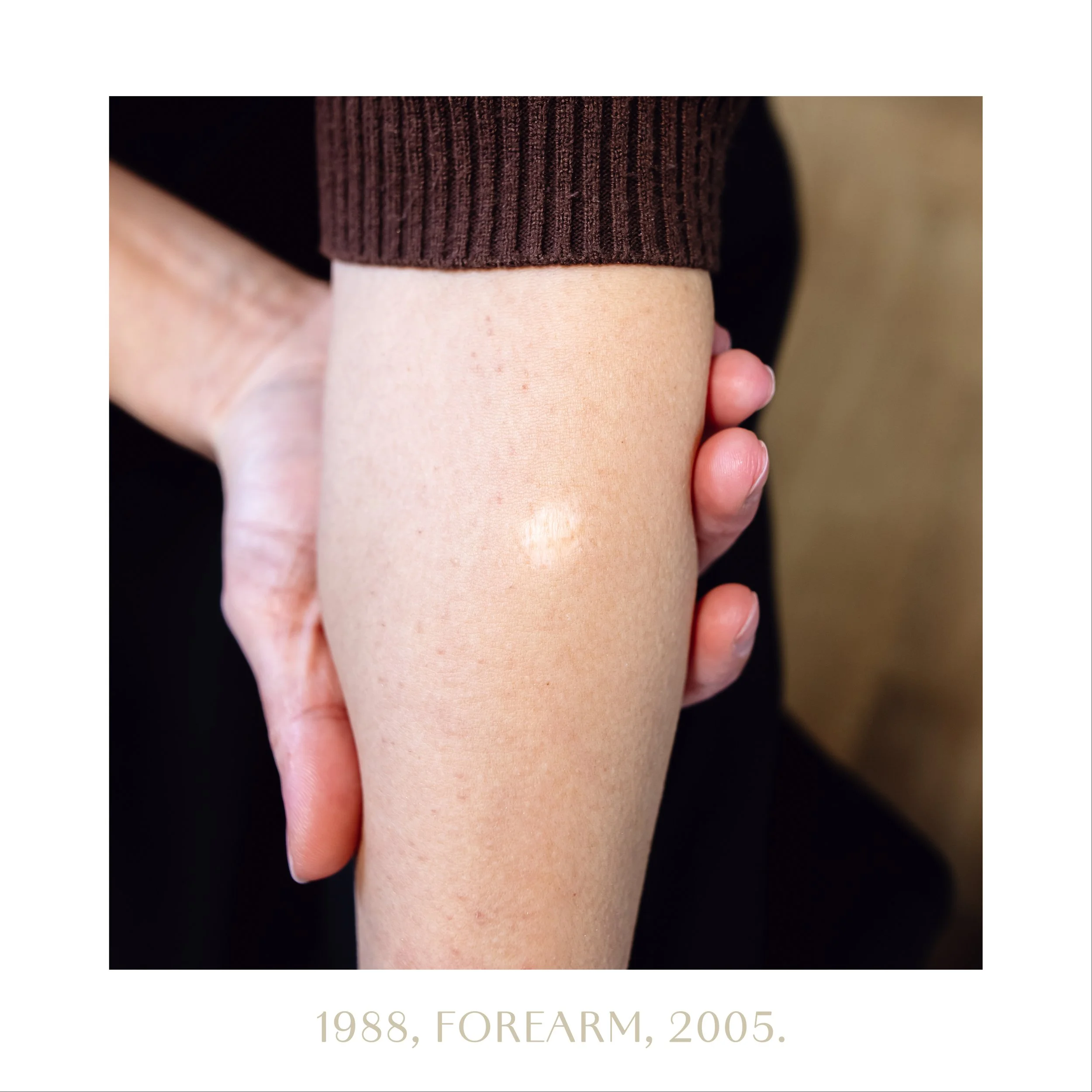 1988, forearm, 2005.jpg