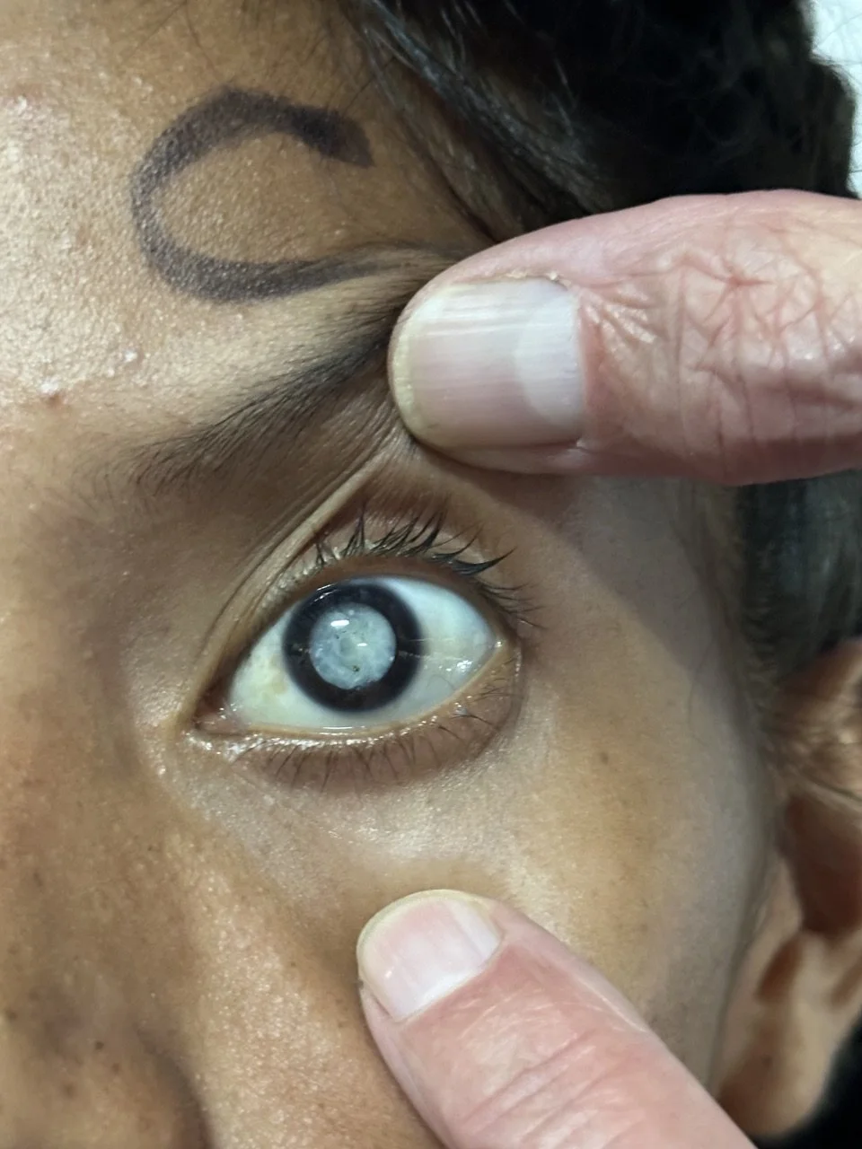 Close-up of a person receiving an eye examination, with a healthcare provider examining the eye using fingers near the eyelid and eyebrow.