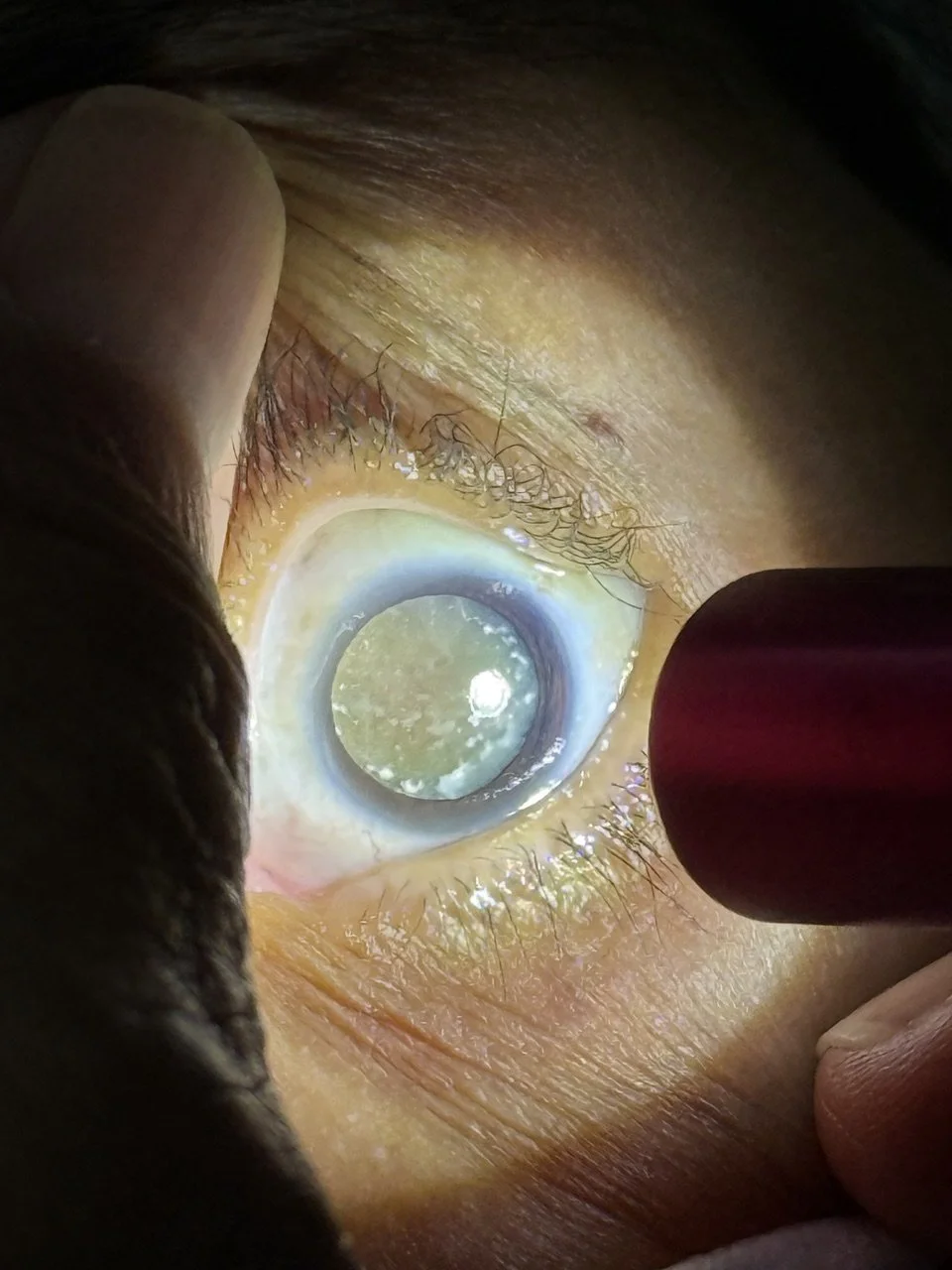 Close-up of a human eye with a bright, illuminated cornea, showing the iris and eyelashes, being examined with an ophthalmoscope or similar device.