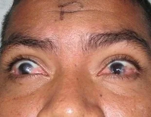 Close-up of a person's forehead and eyes, showing a surgical scar above the eyebrows.