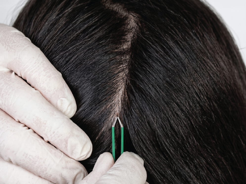 Close-up of a person getting a scalp needle biopsy, with a gloved hand holding the needle near the scalp.