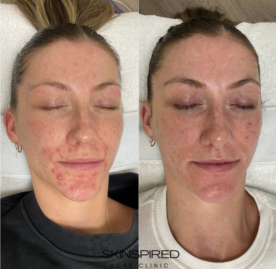 Side-by-side comparison of a woman's face before and after acne treatment, which included an epigenetic report, showing reduced acne and skin inflammation.
