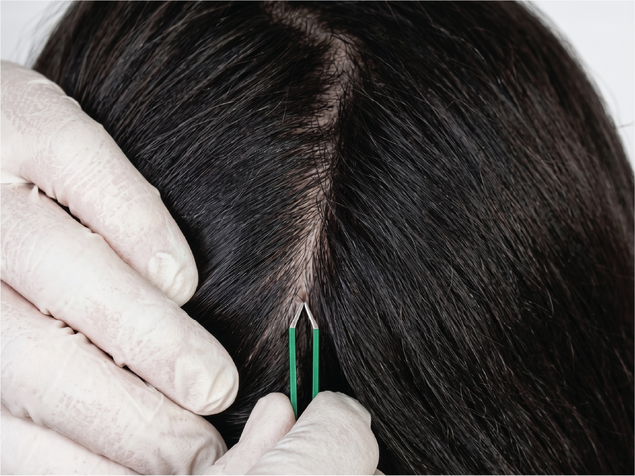 A close-up of a person with dark hair parting their hair with a small scalpel during a hair transplantation procedure, wearing white gloves.