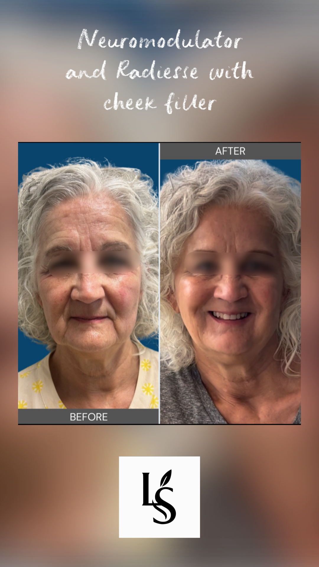 Radiesse
Collagen-stimulating filler for structure and firmness
$699.00 per vial