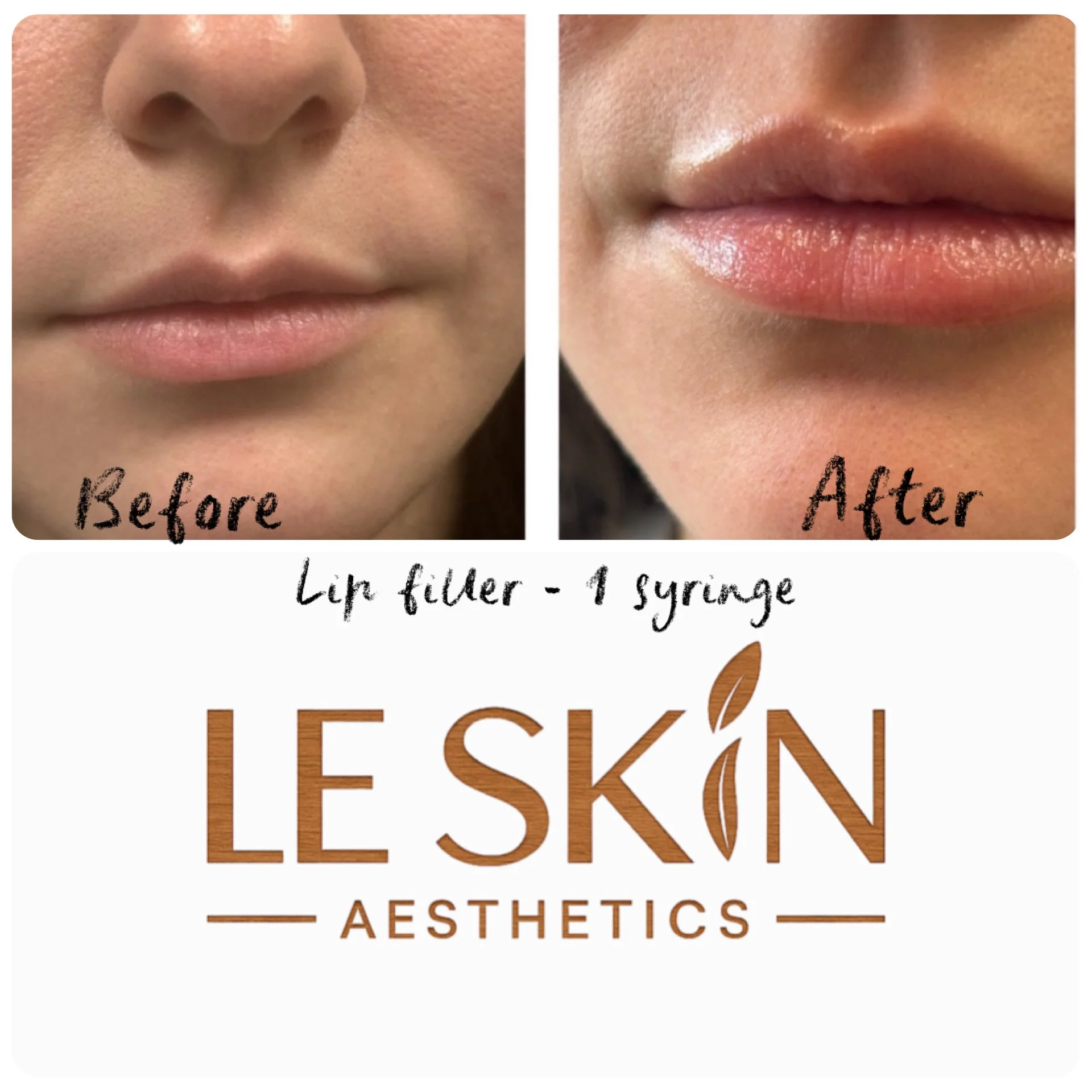 Dermal Fillers
Restore volume and enhance facial contours

Lip Enhancement $600.00

Cheek Filler  $699

Jawline Enhancement  $1,200

Full Face - Starting at $2,000

