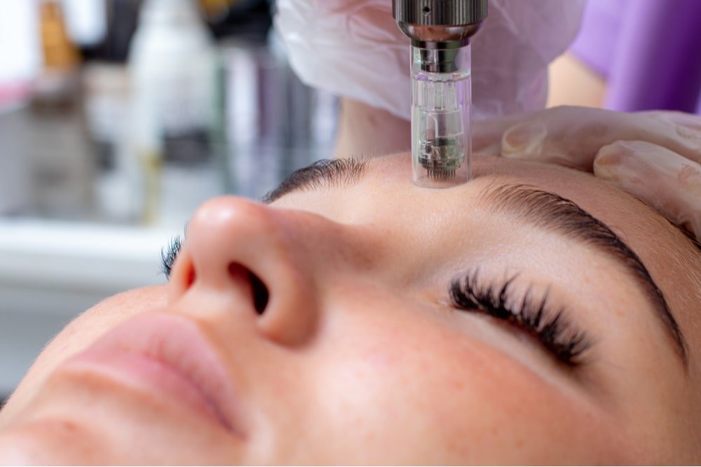 A woman receiving a facial treatment with a microneedling device on her forehead at a skincare clinic