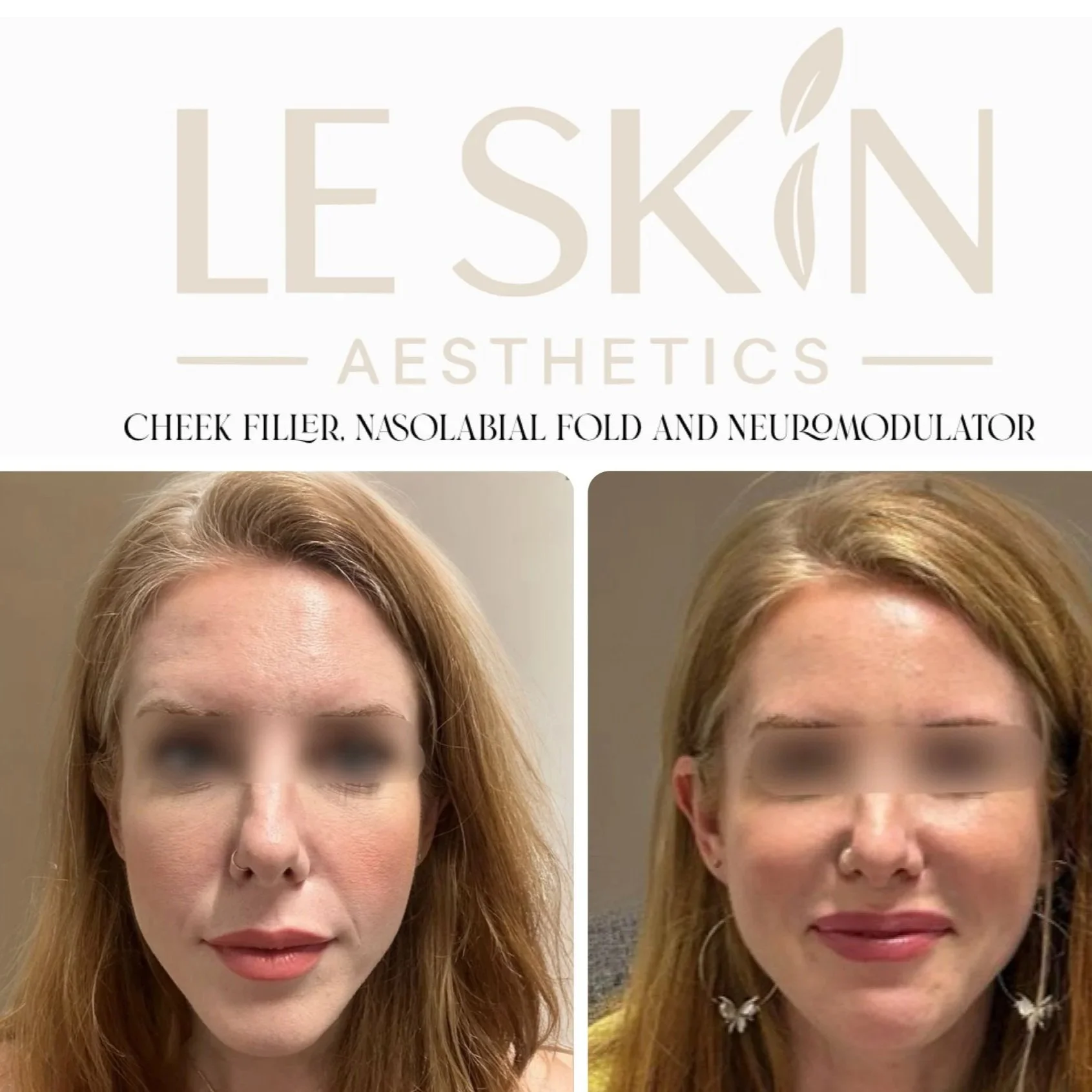 Before and after photo showing a woman with red hair, showcasing cheek filler, nose labial fold, and neuromodulator treatments done by Leskin Aesthetics.