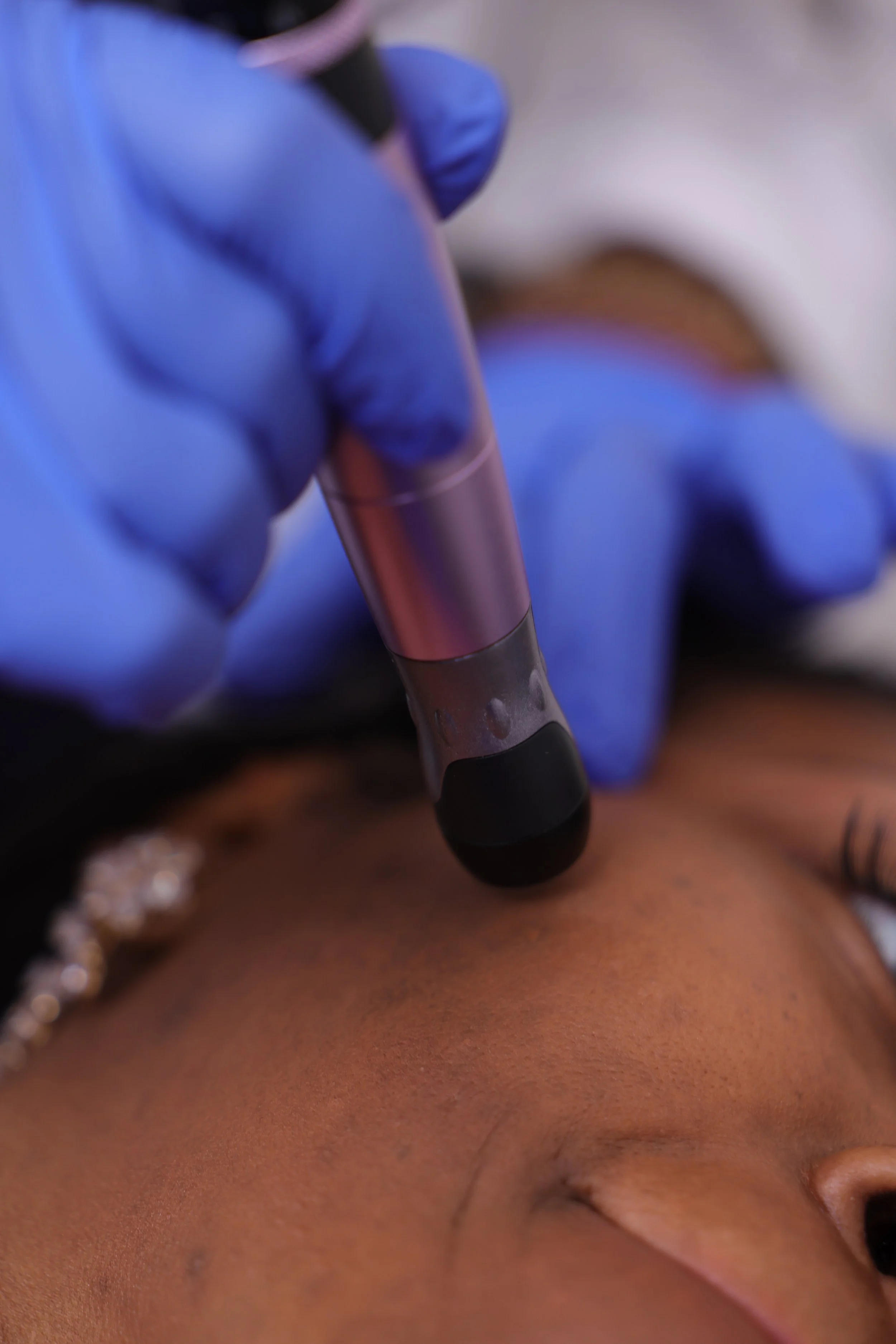 Close-up of a person receiving a cosmetic treatment with a device on their forehead, wearing a blue glove.