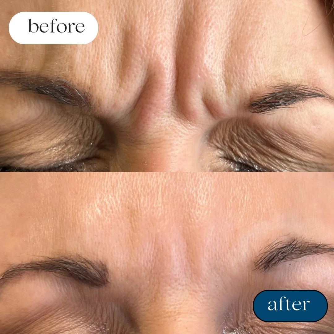 Neuromodulators 
(Jeuveau®, Daxxify®, Xeomin®, Letybo®)

Smooths dynamic wrinkles for a refreshed appearance

*Consultation required- Pricing Per Unit