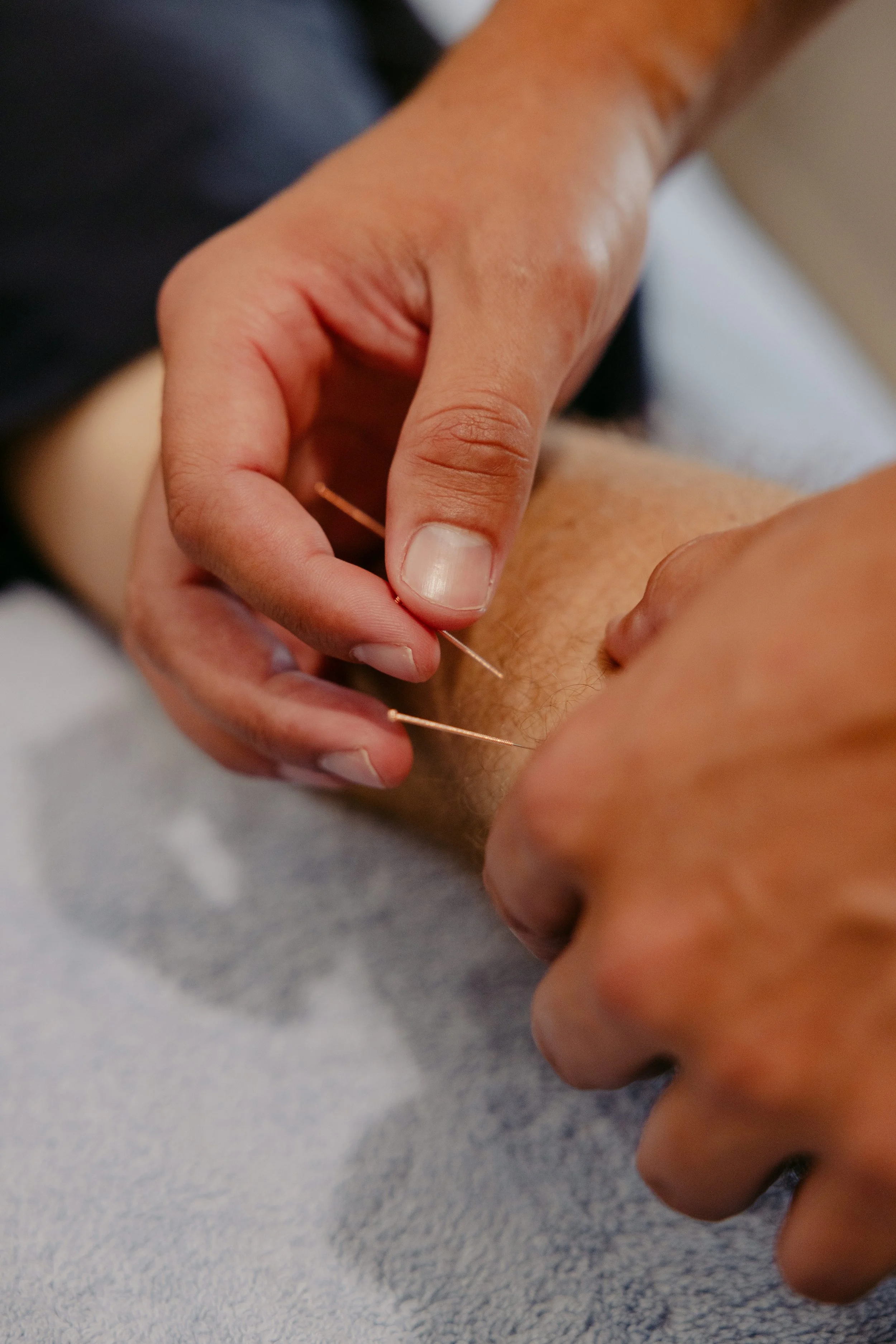 A person performing acupuncture by inserting thin needles into a patient's arm.