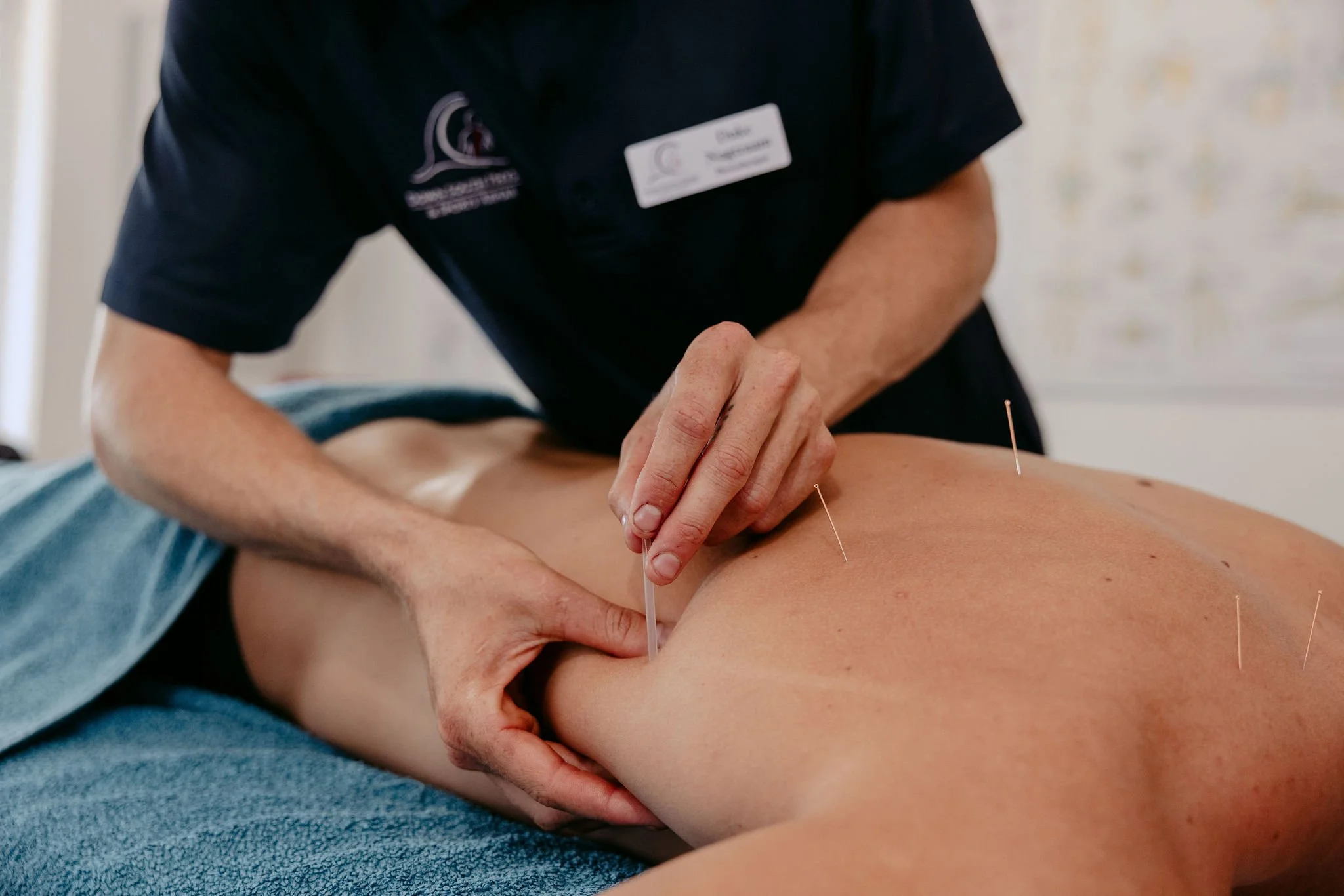 A healthcare professional performs acupuncture on a patient's back using thin needles.