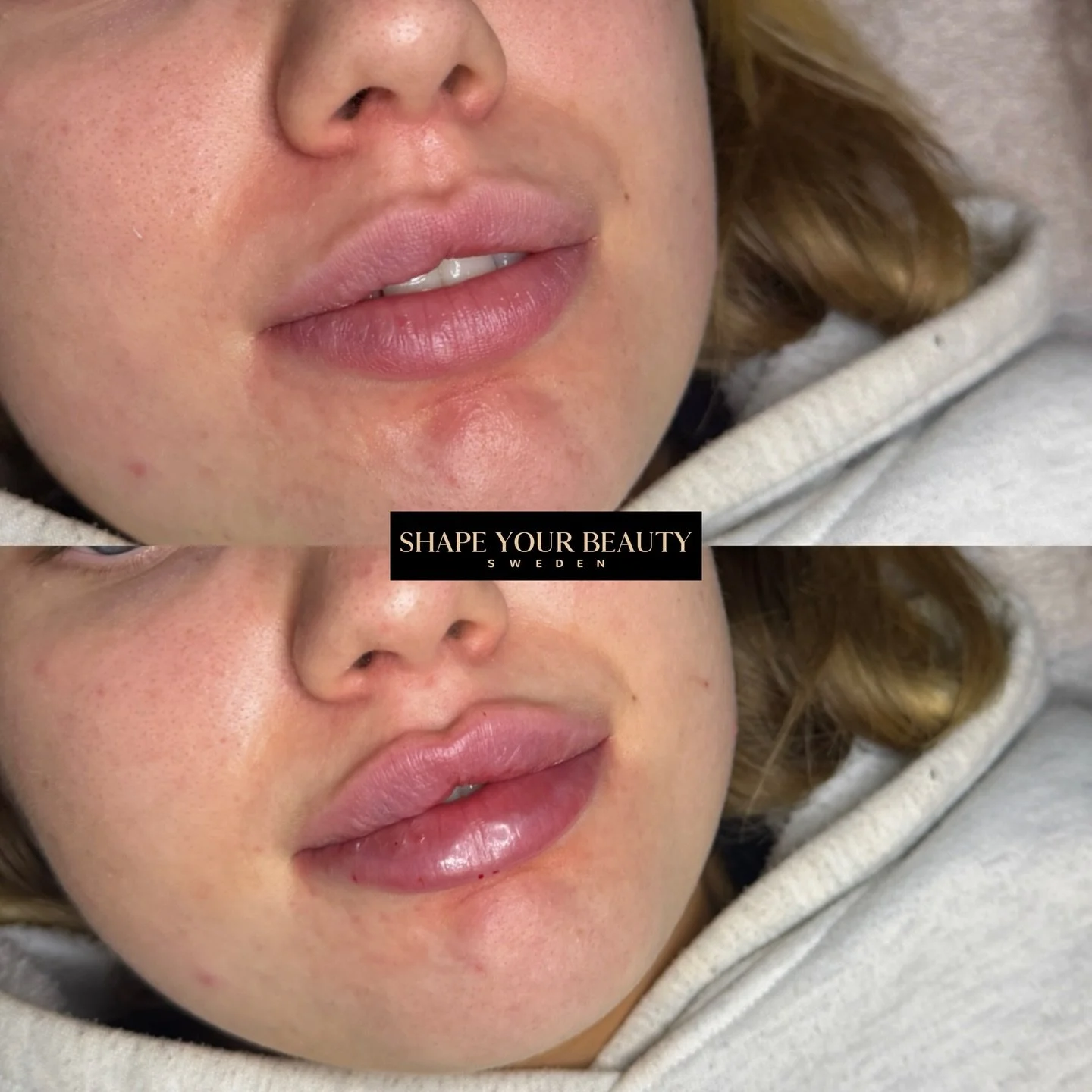 L&auml;ppar behandlade med 1 ml filler med tekniken Russian Lips.
I detta fall har l&auml;pparna specialbehandlats p&aring; grund av tidigare filler, d&auml;r en st&ouml;rre kn&ouml;l hade bildats p&aring; h&ouml;ger sida av &ouml;verl&auml;ppen. Den