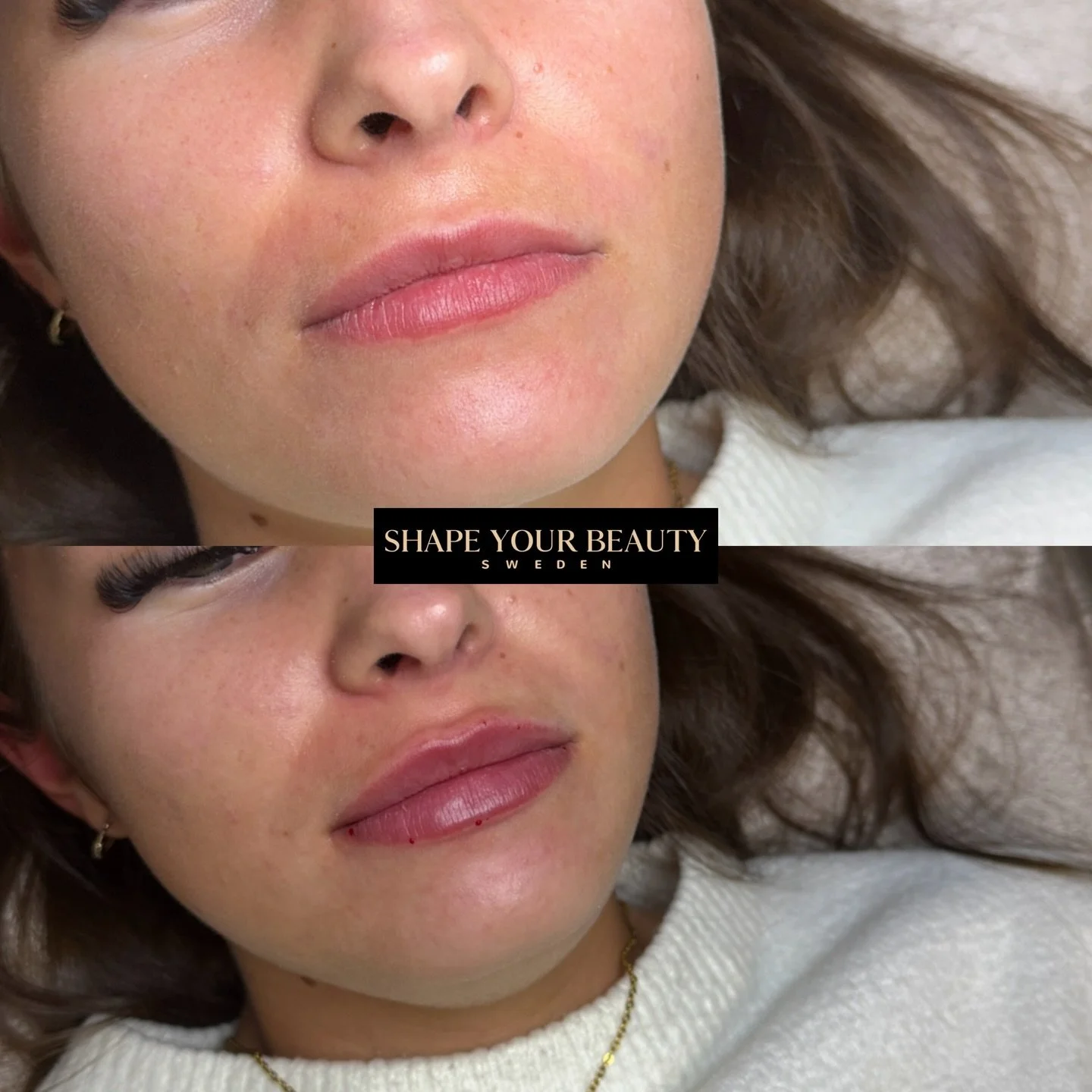 P&aring;fyll med endast 0,5ml med v&aring;r egna teknik classy lips 👄. Denna teknik framh&auml;ver dina naturligt fina l&auml;ppar med mer kontur, lyft och volym. V&auml;lkommen att boka en kostnadsfri konsultation f&ouml;r en behandling skr&auml;dd