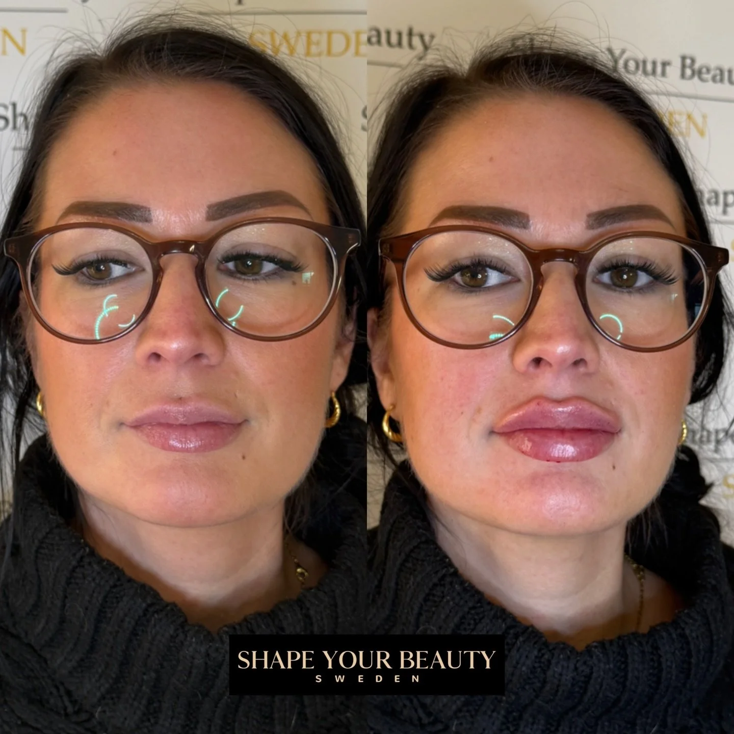 1ml Russian lips👄 h&auml;r har vi fokuserat p&aring; ett lyft, volym och en krispig form. Slutresultatet kan du se efter 2 veckor n&auml;r svullnaden f&ouml;rsvunnit. Vid fr&aring;gor kan ni kontakta mig via DM💗