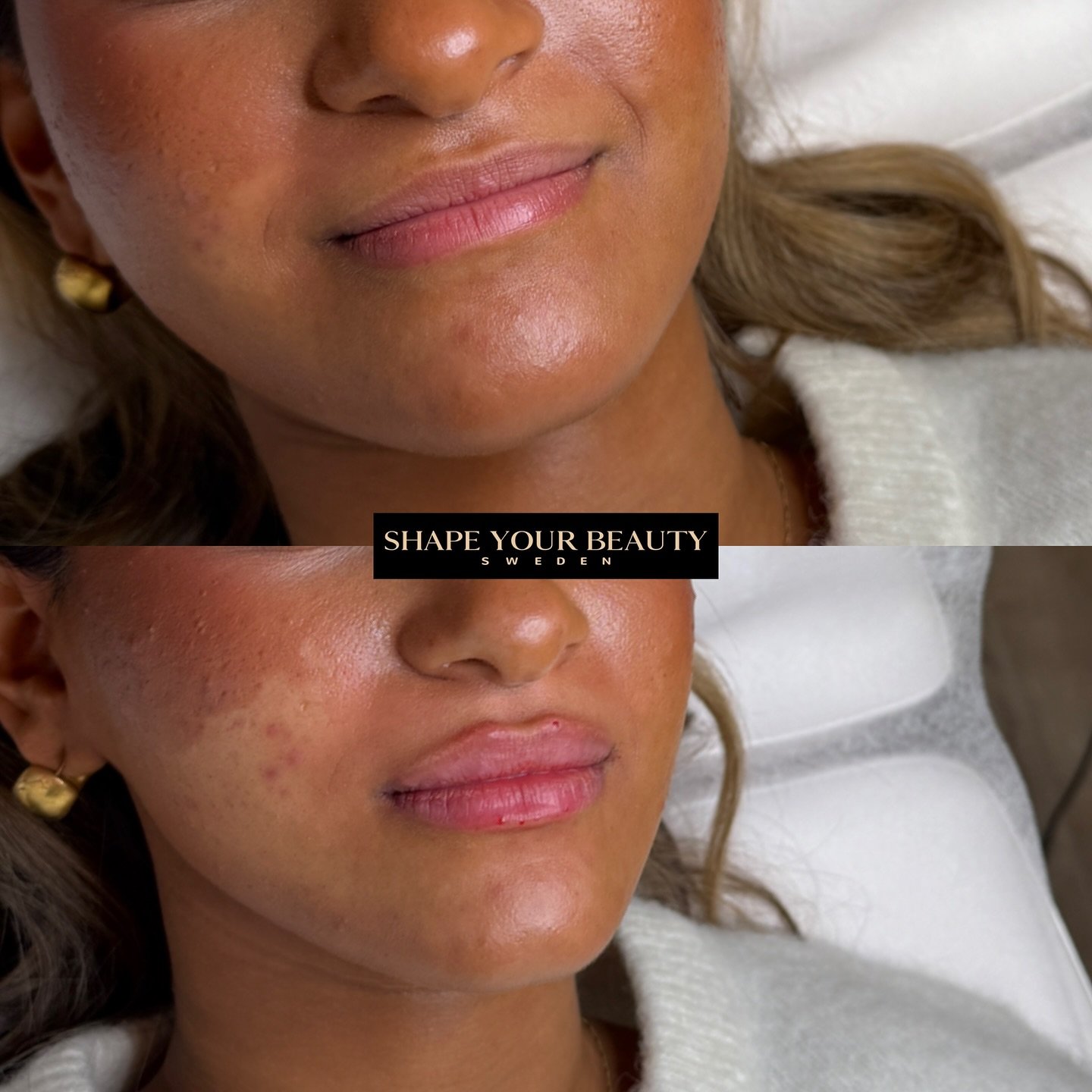 Classy Lips 
Hos Shape Your Beauty Sweden erbjuder vi fillers med v&aring;r egen teknik Classy Lips &ndash; en metod som fokuserar p&aring; ett subtilt lyft av &ouml;verl&auml;ppen f&ouml;r att skapa balans och harmoni i ansiktet.

L&auml;pparna ska 