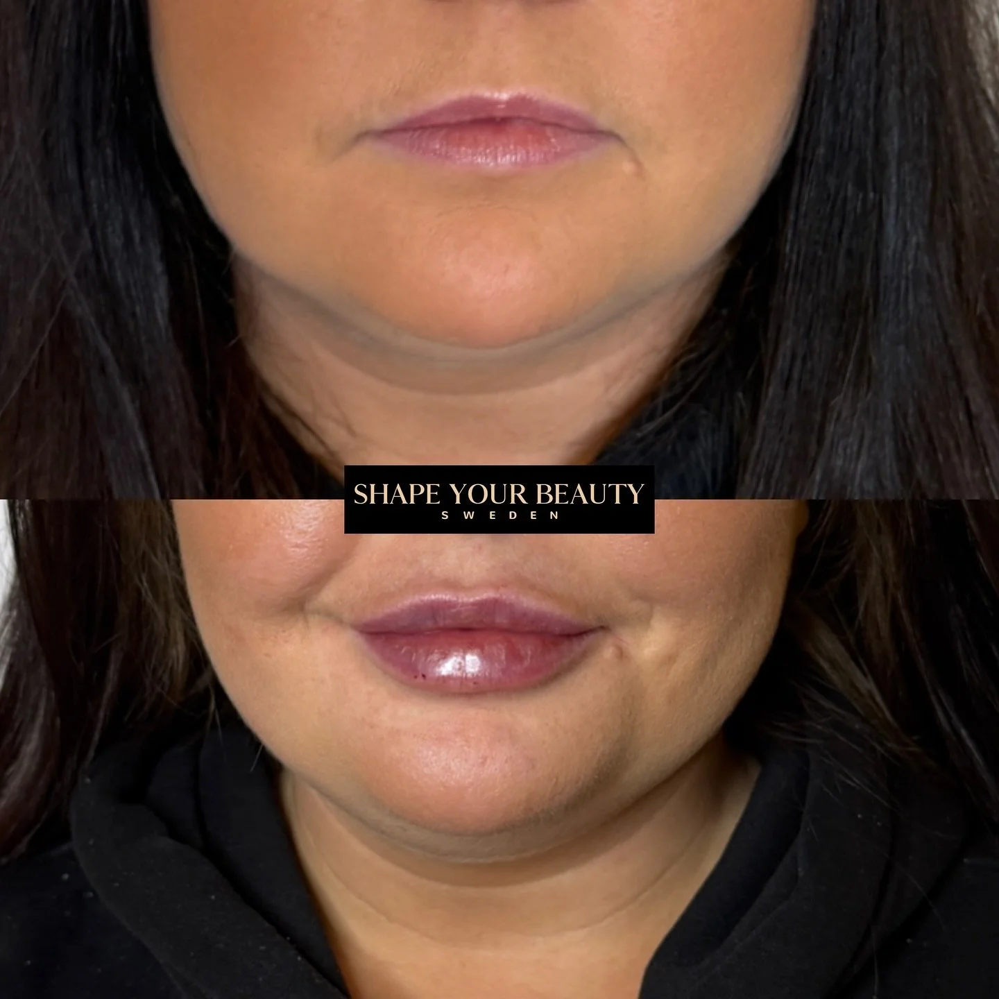 Denna kund har behandlats med 1 ml filler, d&auml;r vi kombinerat teknikerna Russian Lips och v&aring;r egen signaturmetod Classy Lips.
Syftet med behandlingen var att skapa ett naturligt och balanserat lyft av &ouml;verl&auml;ppen, vilket framh&auml