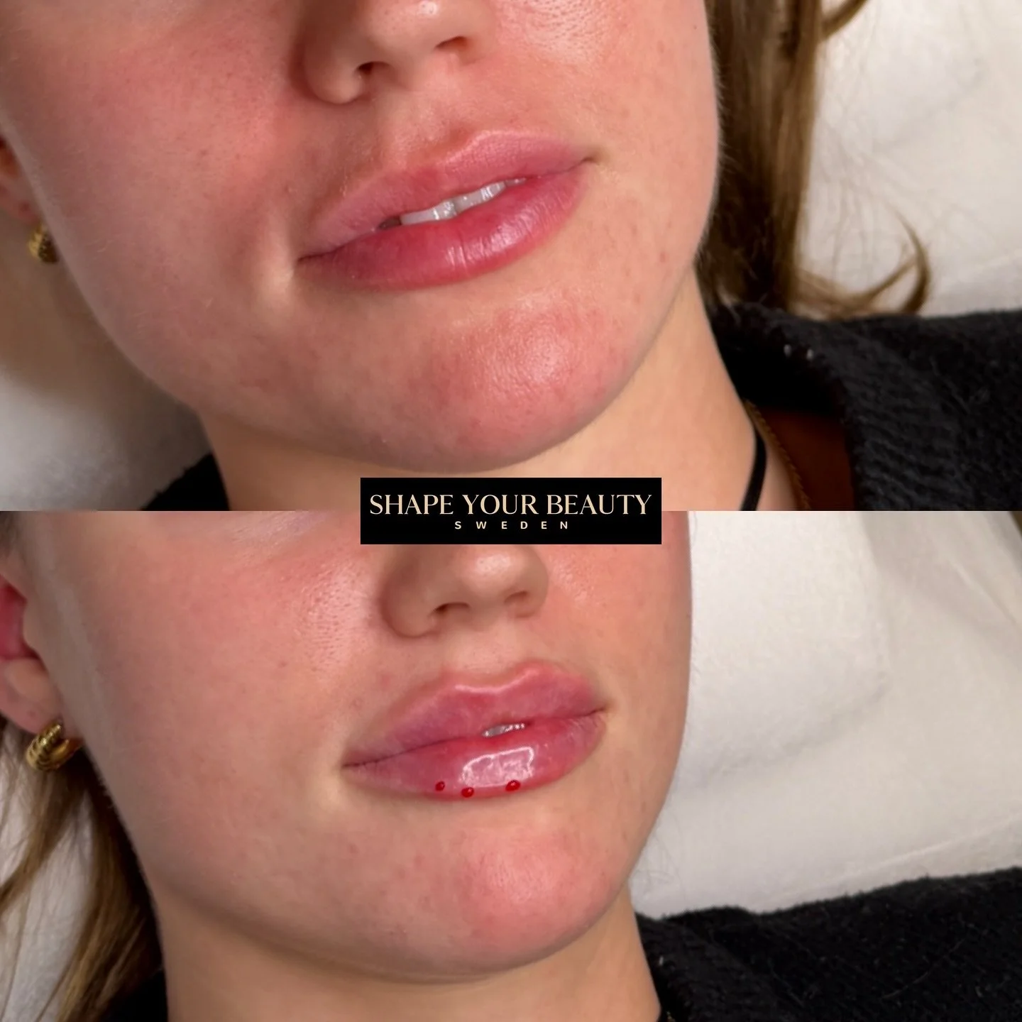 H&auml;r har vi injicerat 0,8ml filler med v&aring;r egen teknik Classy Lips. Med denna teknik fokuserar vi p&aring; ett lyft av &ouml;verl&auml;ppen som skapar balans och harmoni i ansiktet.

L&auml;ppar ska inte ta &ouml;ver dina andra vackra drag 