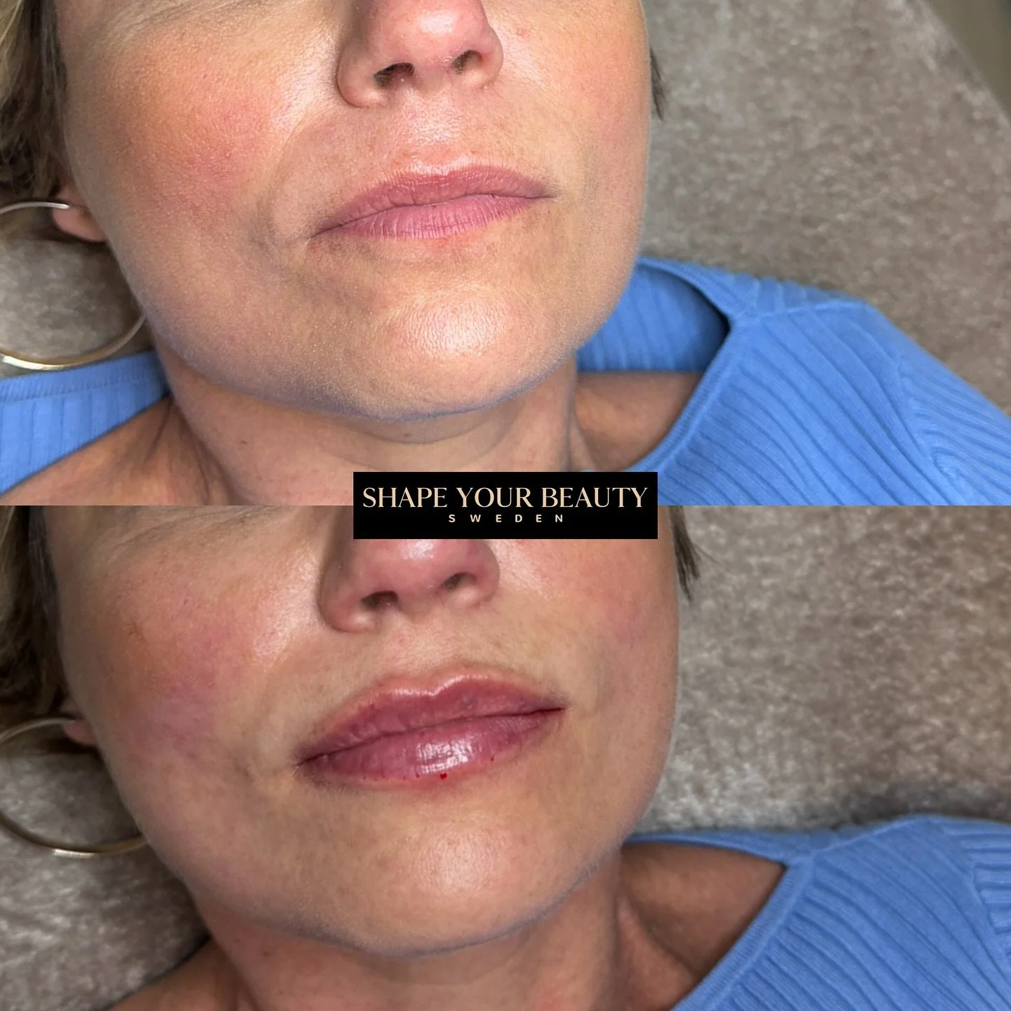 Kundens f&ouml;rsta fillerbehandling ✨
H&auml;r har vi injicerat 1 ml filler med v&aring;r egen teknik Classy Lips. Med denna metod fokuserar vi p&aring; ett lyft av &ouml;verl&auml;ppen som skapar balans och harmoni i ansiktet.

L&auml;ppar ska inte