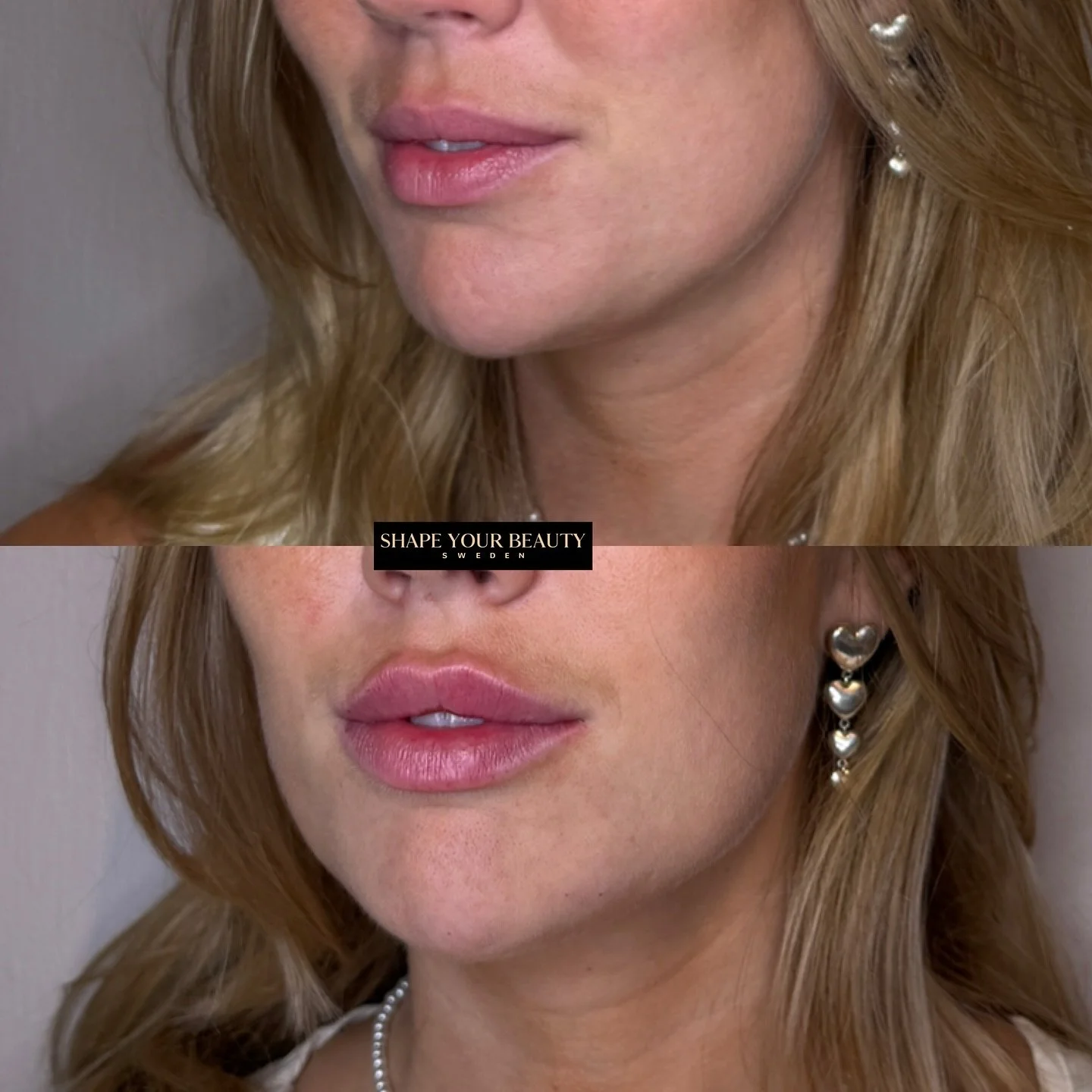 🌸 Naturlig sk&ouml;nhet i fokus 🌸
0,6 ml r&auml;cker l&aring;ngt f&ouml;r att framh&auml;va l&auml;pparnas form och ge vackra konturer p&aring; denna kund. Diskret, elegant och helt anpassat efter kundens &ouml;nskem&aring;l 💕