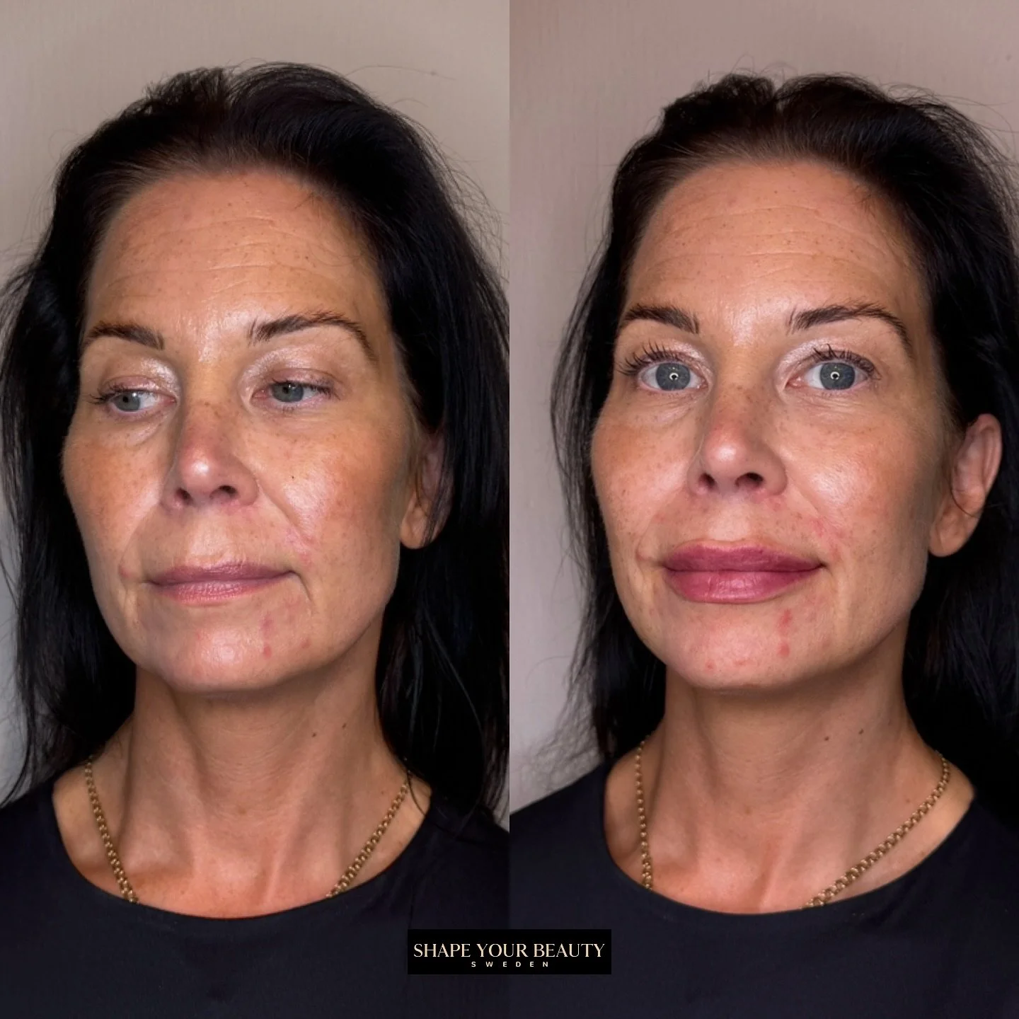 ✨ 1 ml l&auml;ppar kan g&ouml;ra stor skillnad! ✨
Vi anpassar alltid injektionstekniken efter dina &ouml;nskem&aring;l och ditt unika utg&aring;ngsl&auml;ge.
Varmt v&auml;lkommen p&aring; en kostnadsfri konsultation &ndash; tillsammans l&auml;gger vi