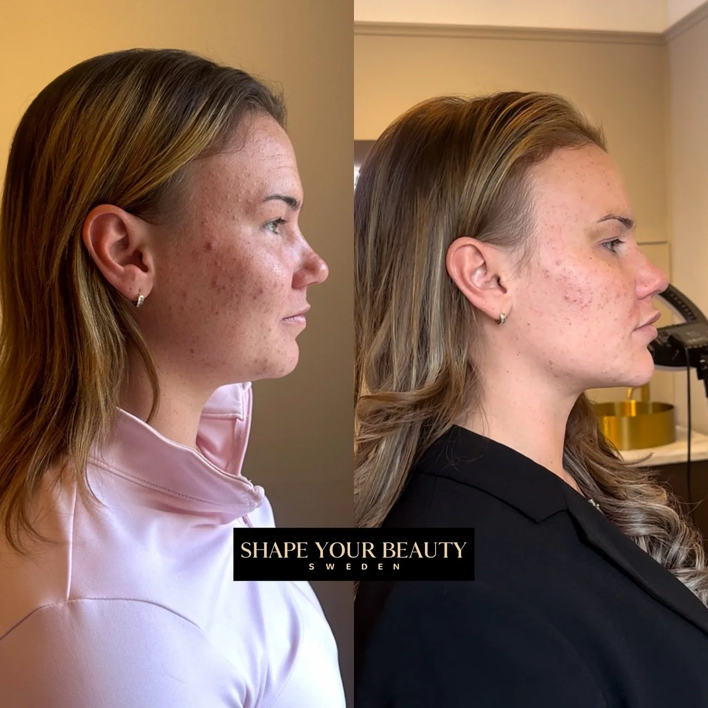 Profilbalansering p&aring; fina Alexandra, 4 veckor mellan bilderna. Vi har behandlat k&auml;klinje, kindben, haka och l&auml;ppar med fillers🫶🏻 det fina med alla sk&ouml;nhetsbehandlingar &auml;r att du sj&auml;lv best&auml;mmer vad just du vill g